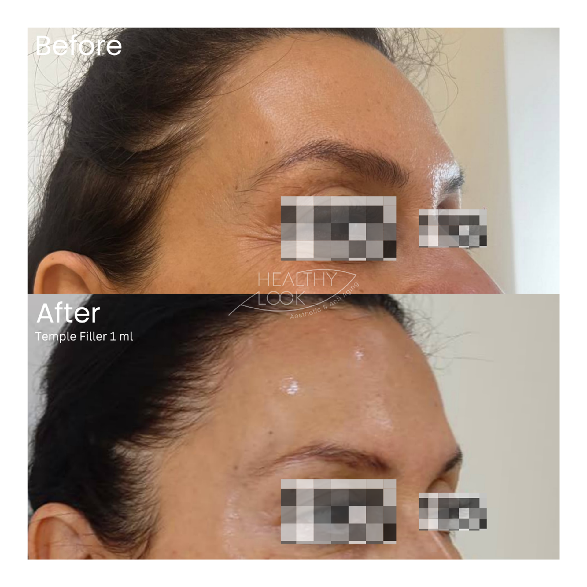 Before and after result 6 for Dermal Filler treatment at Healthy Look Aesthetic