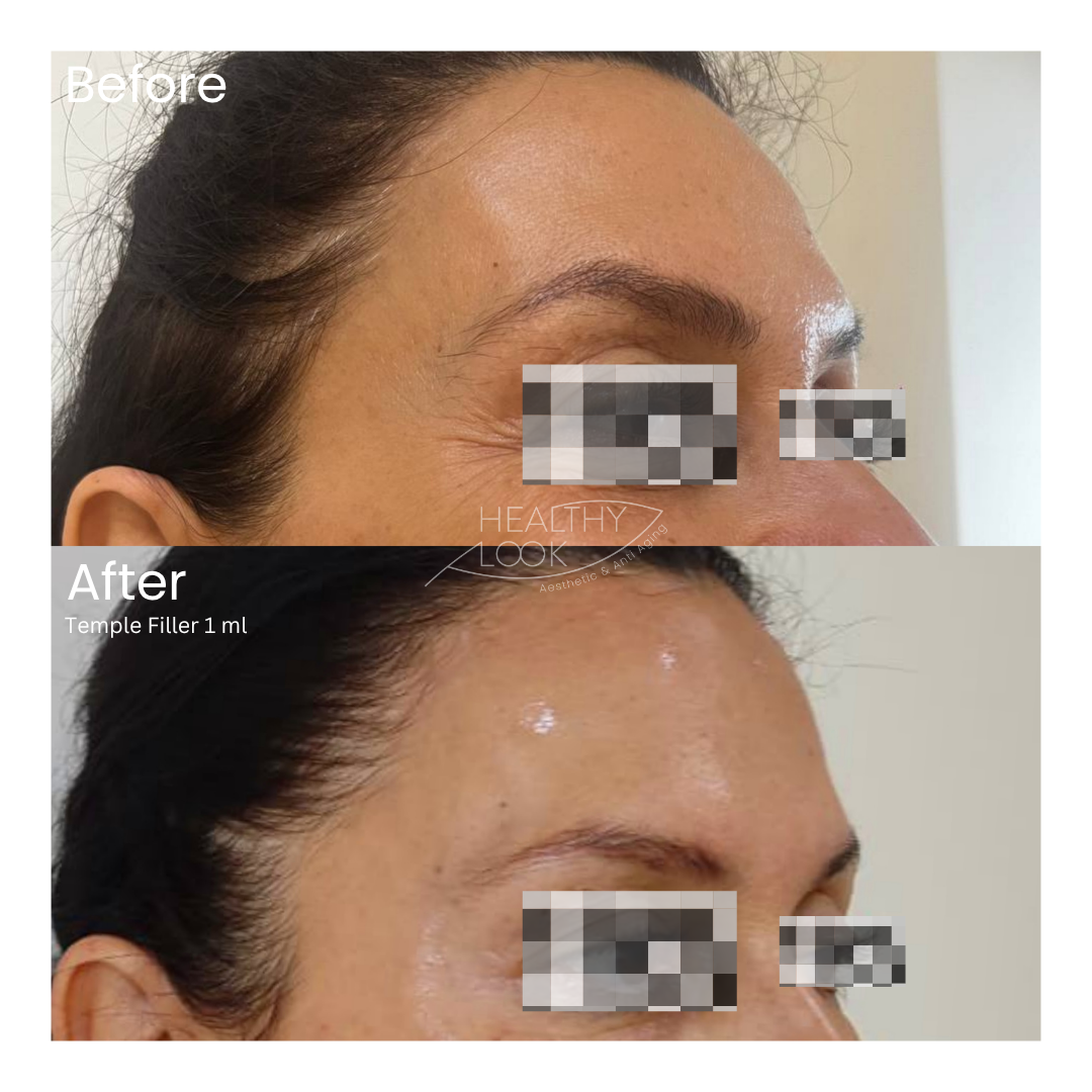 Before and after result 6 for Dermal Filler treatment at Healthy Look Aesthetic