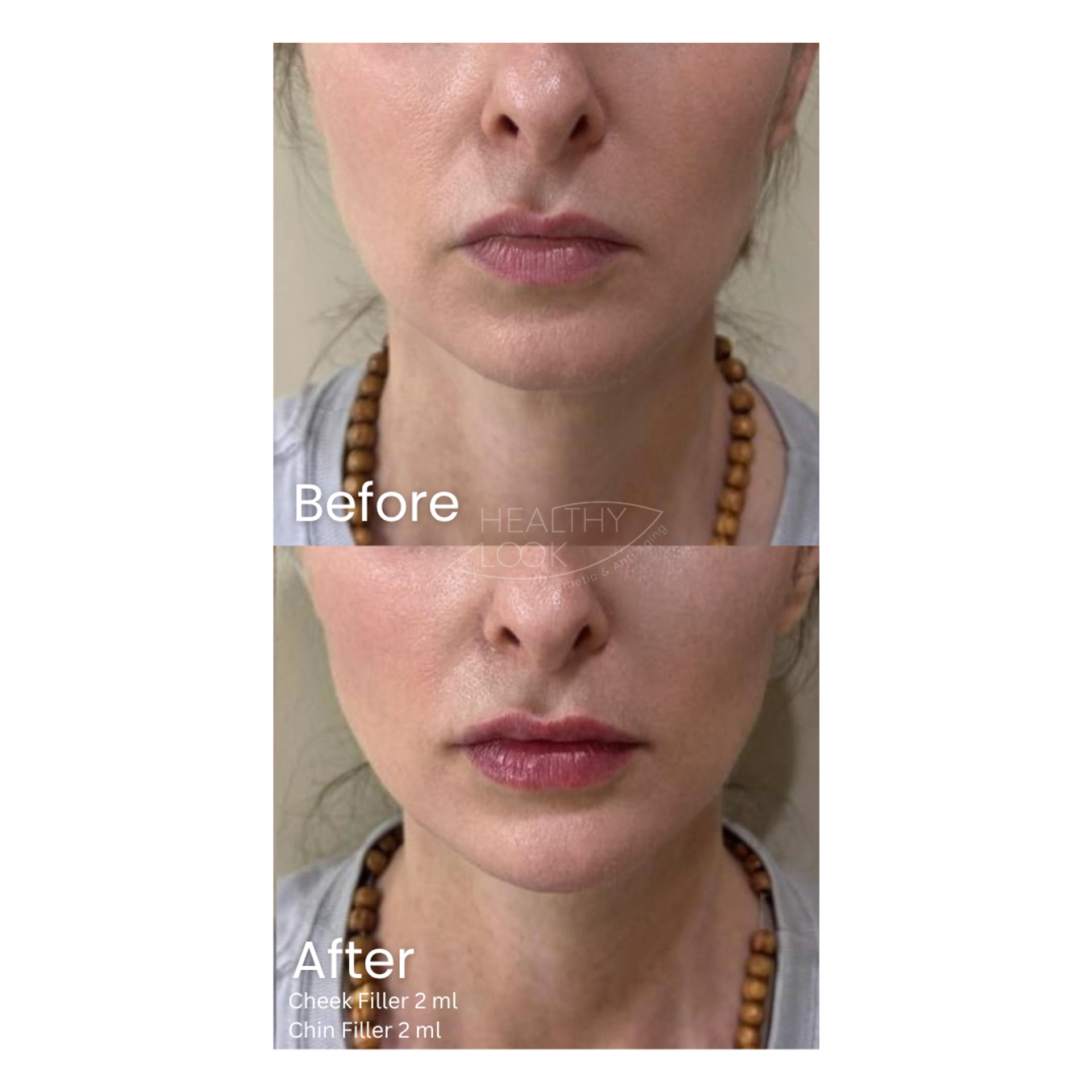 Before and after result 2 for Dermal Filler treatment at Healthy Look Aesthetic