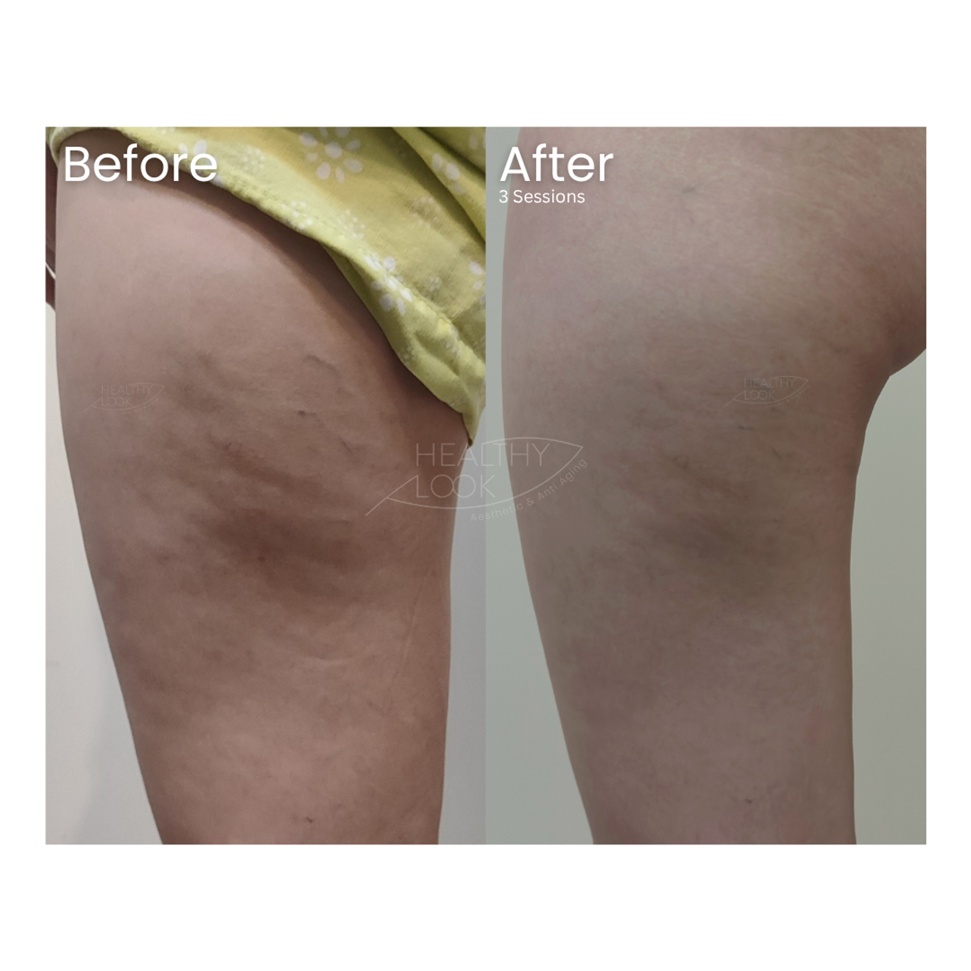 Before and after result 2 for Lysiwave treatment at Healthy Look Aesthetic