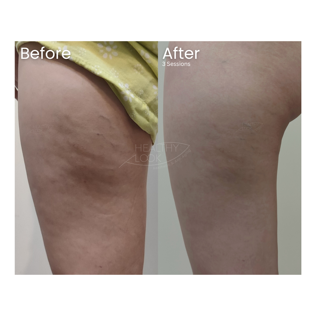 Before and after result 2 for Lysiwave treatment at Healthy Look Aesthetic