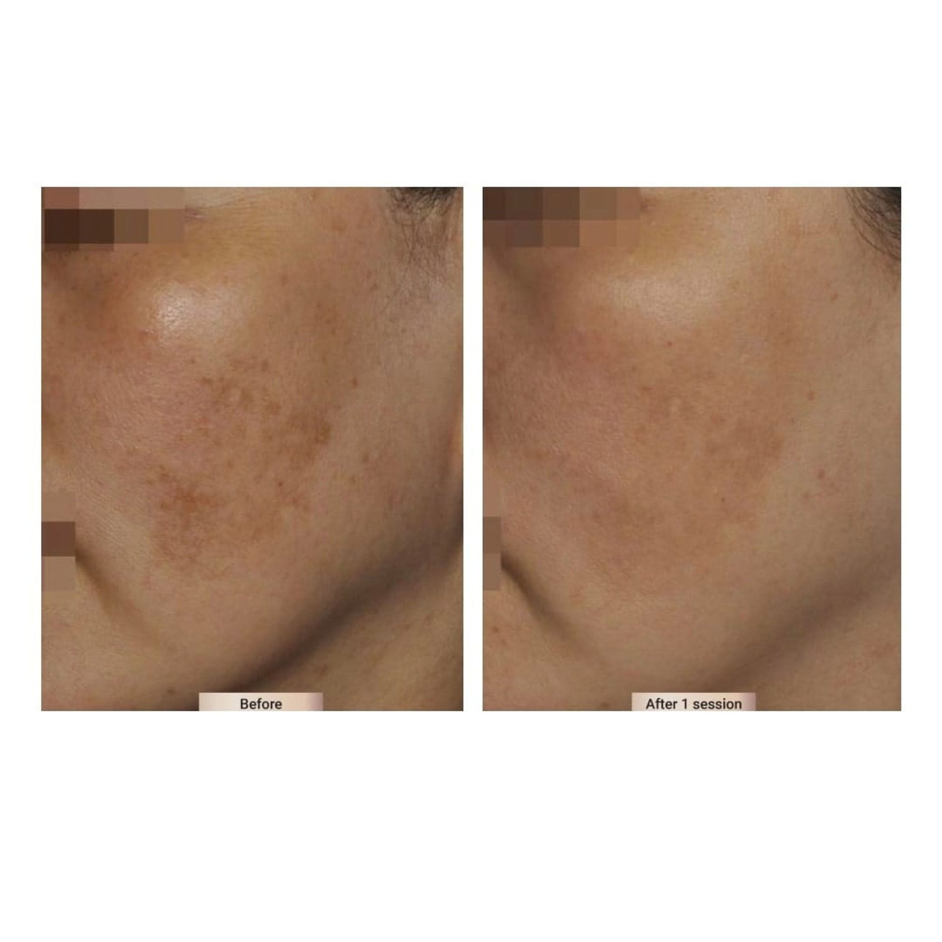 Before and after result 6 for Sylfirm X treatment at Healthy Look Aesthetic