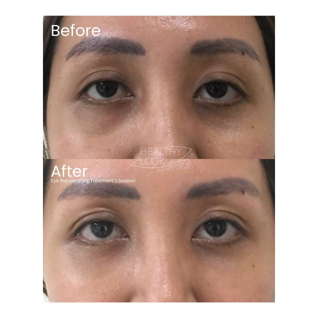 Before and after result 3 for Skin Treatment treatment at Healthy Look Aesthetic