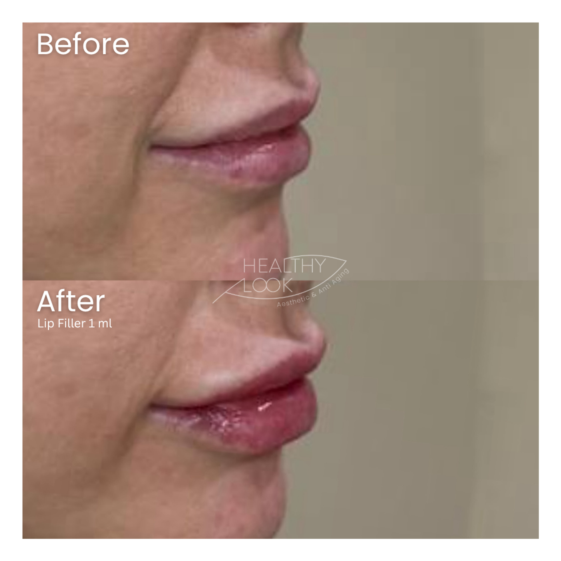 Before and after result 2 for Lip Filler treatment at Healthy Look Aesthetic