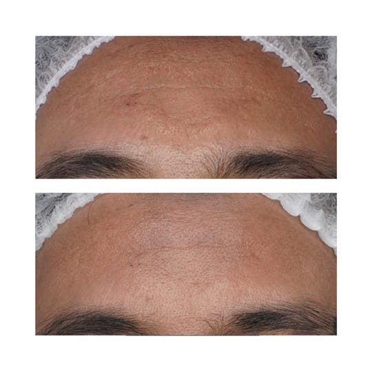 Before and after result 10 for Juvelook treatment at Healthy Look Aesthetic