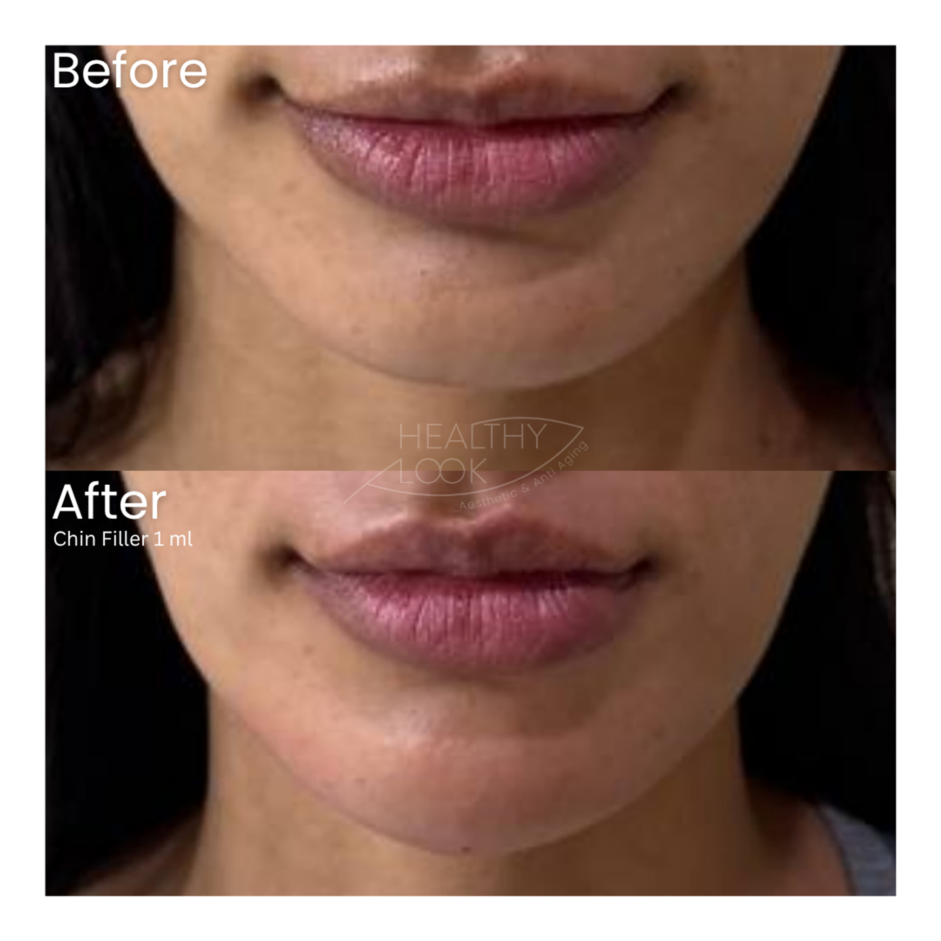 Before and after result 13 for Dermal Filler treatment at Healthy Look Aesthetic
