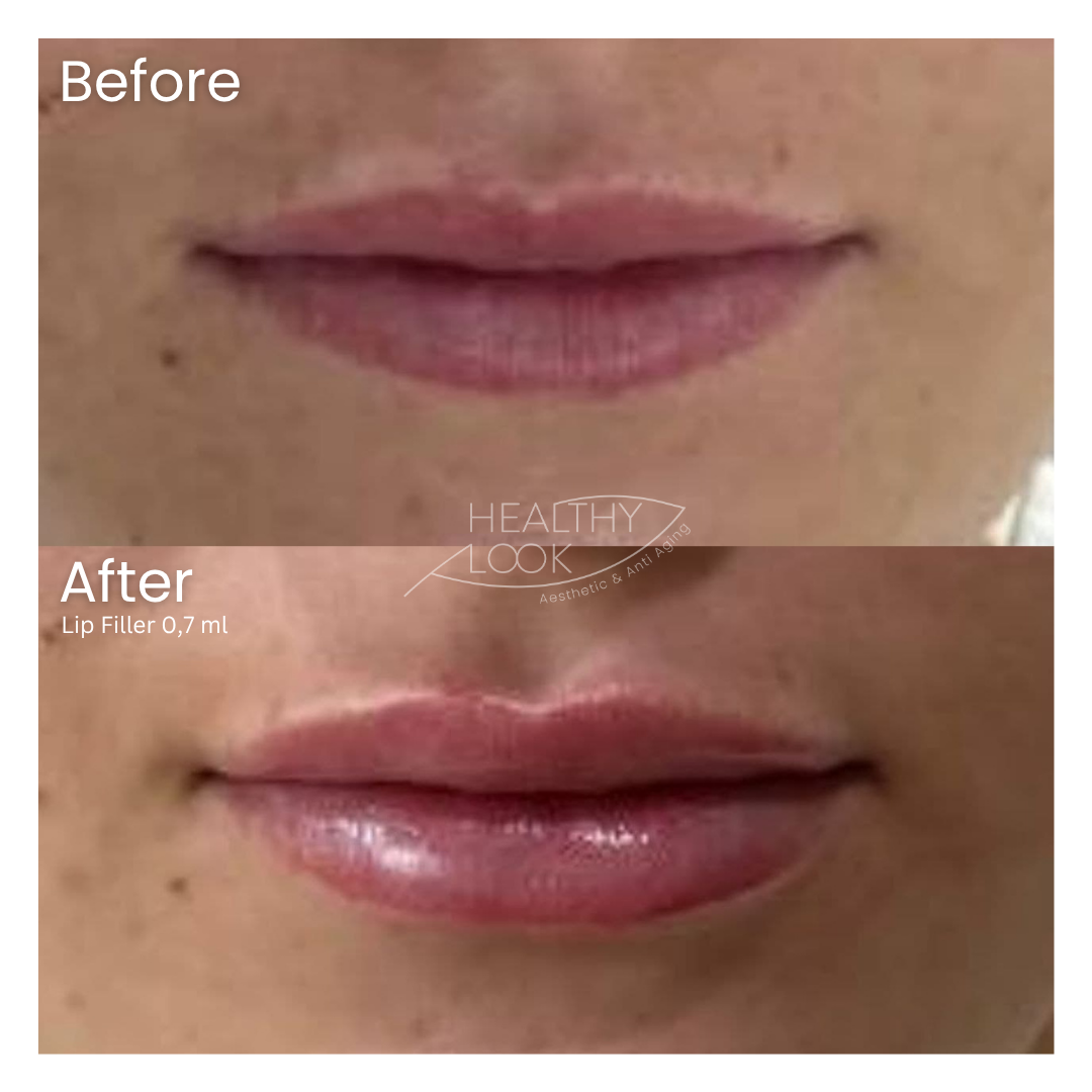 Before and after result 15 for Lip Filler treatment at Healthy Look Aesthetic