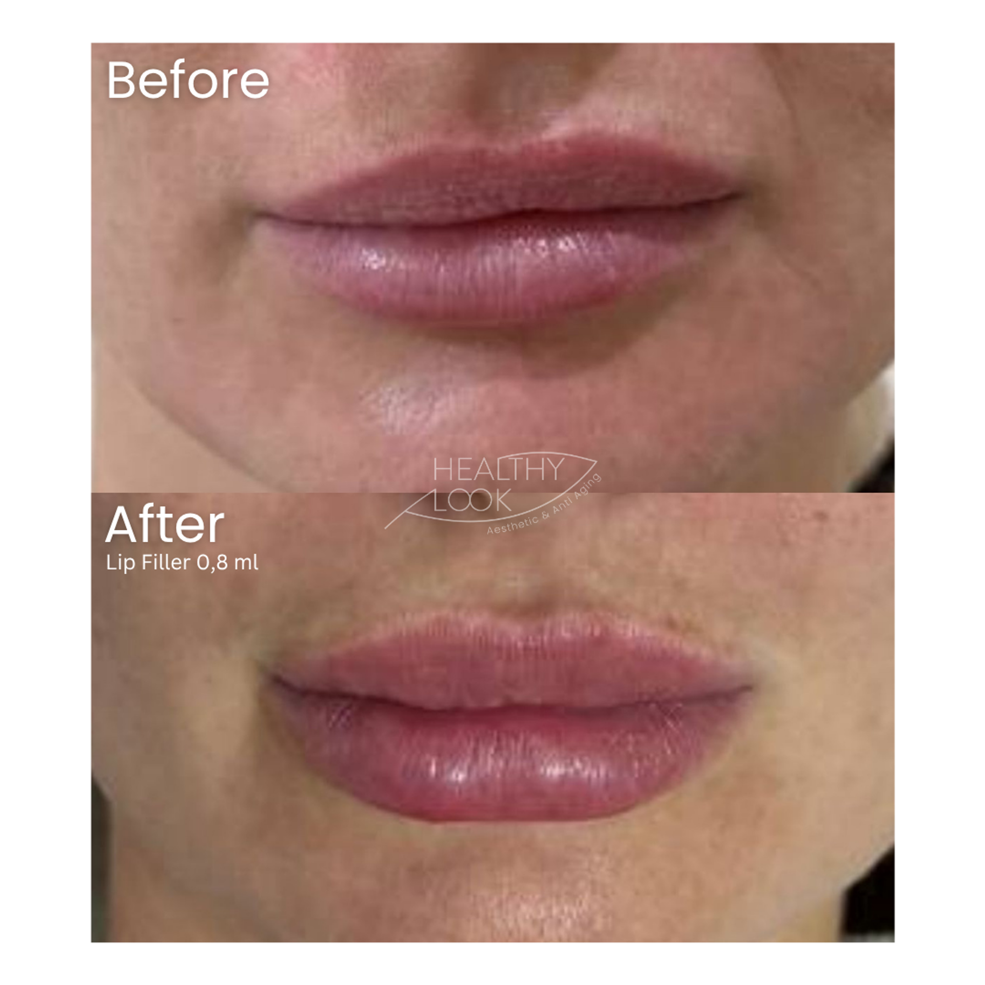 Before and after result 17 for Lip Filler treatment at Healthy Look Aesthetic