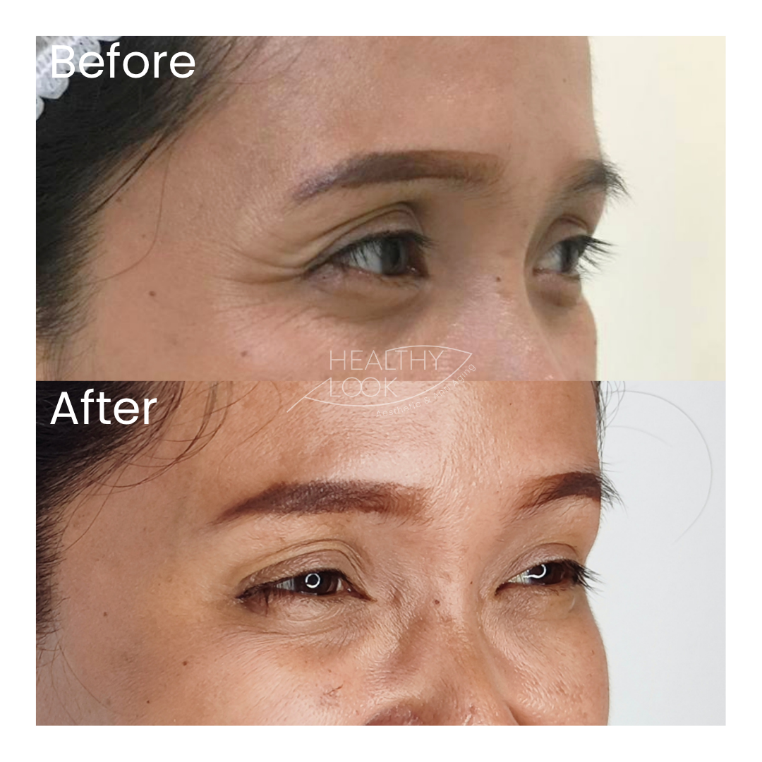 Before and after result 13 for Botox treatment at Healthy Look Aesthetic