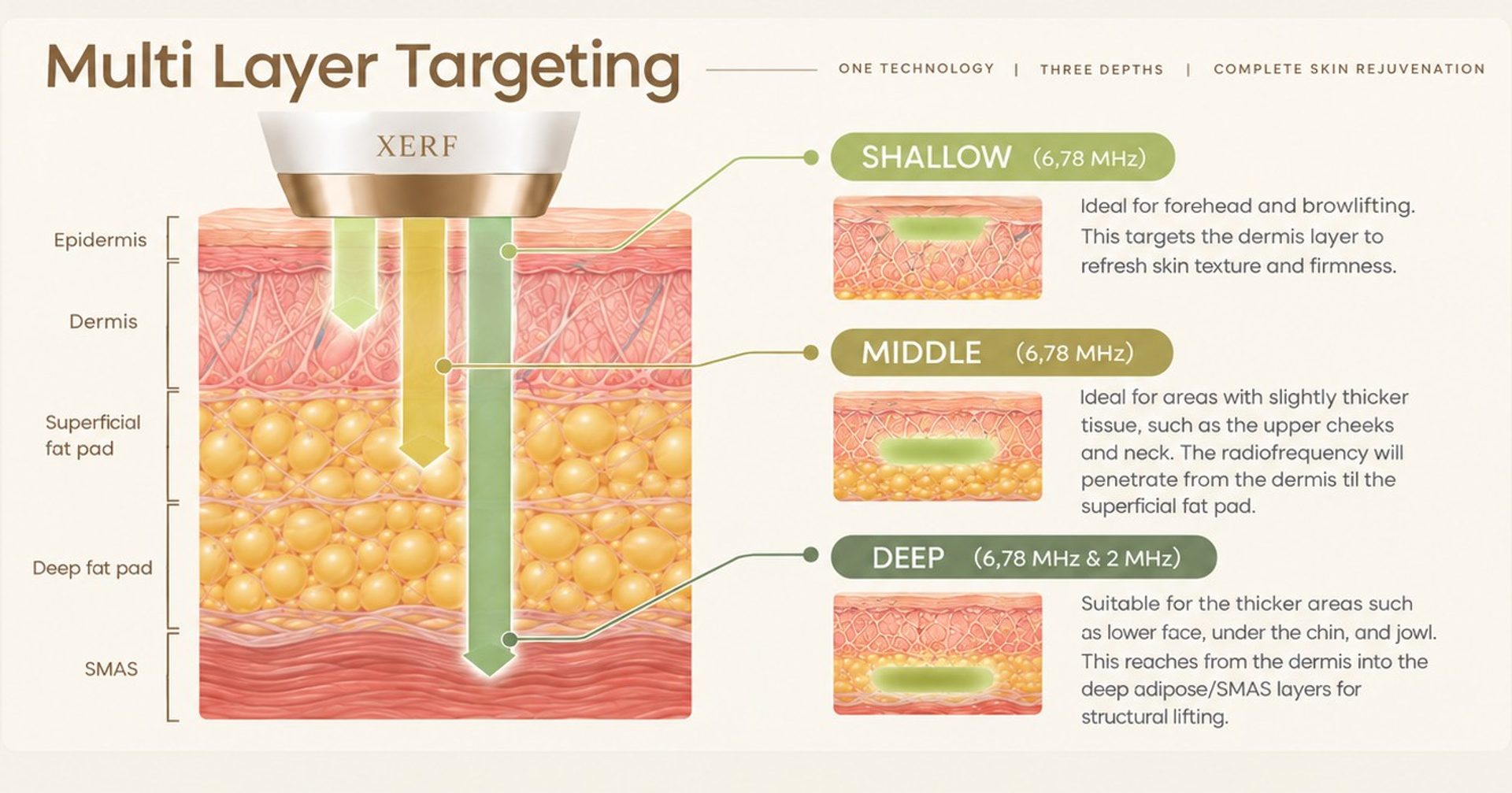 XERF multi-layer targeting diagram: shallow at 6.78 MHz for the forehead and brow, middle at 6.78 MHz for upper cheeks and neck, and deep at 6.78 MHz plus 2 MHz for the lower face, under the chin and jowl.