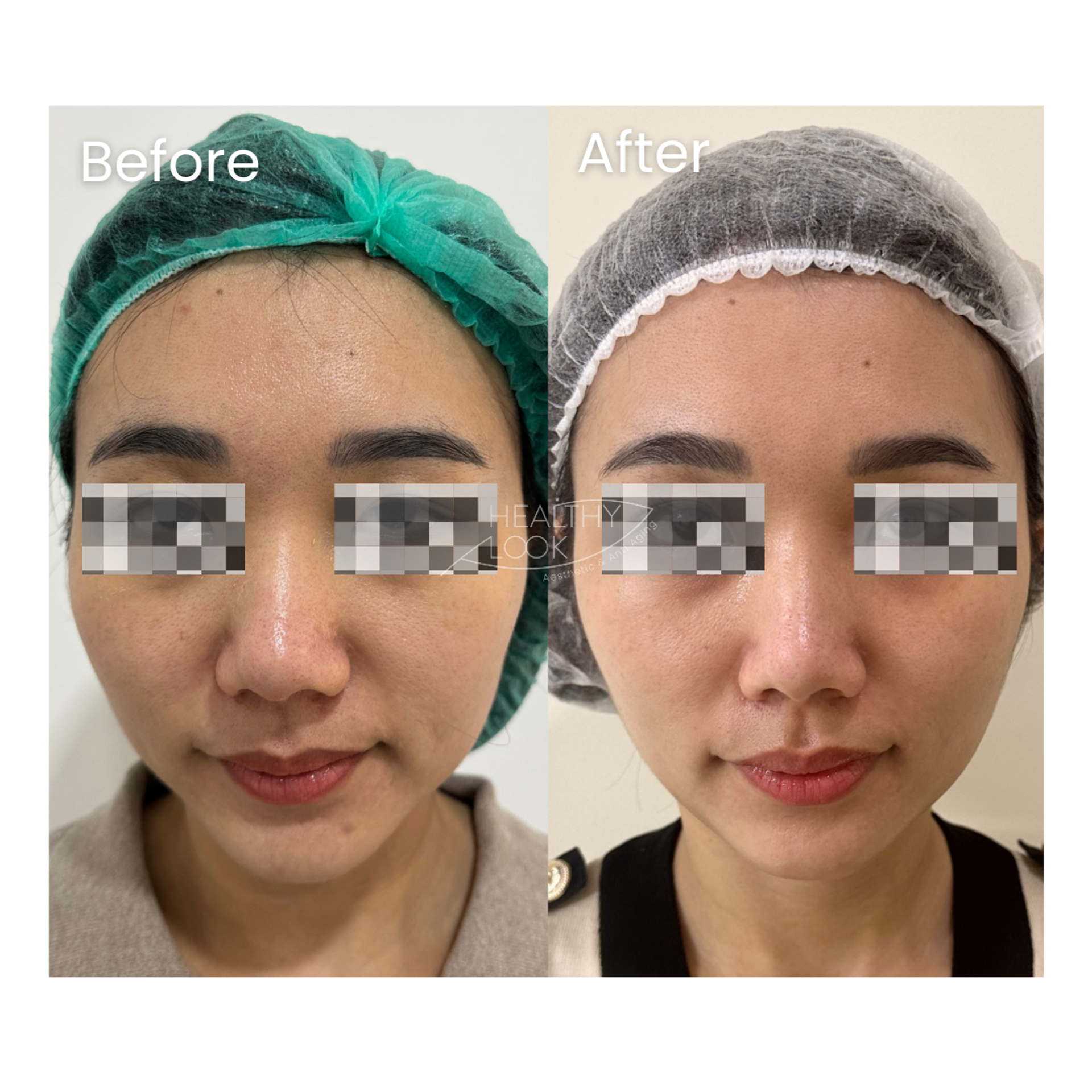 Premium HIFU by Linear Z before and after result