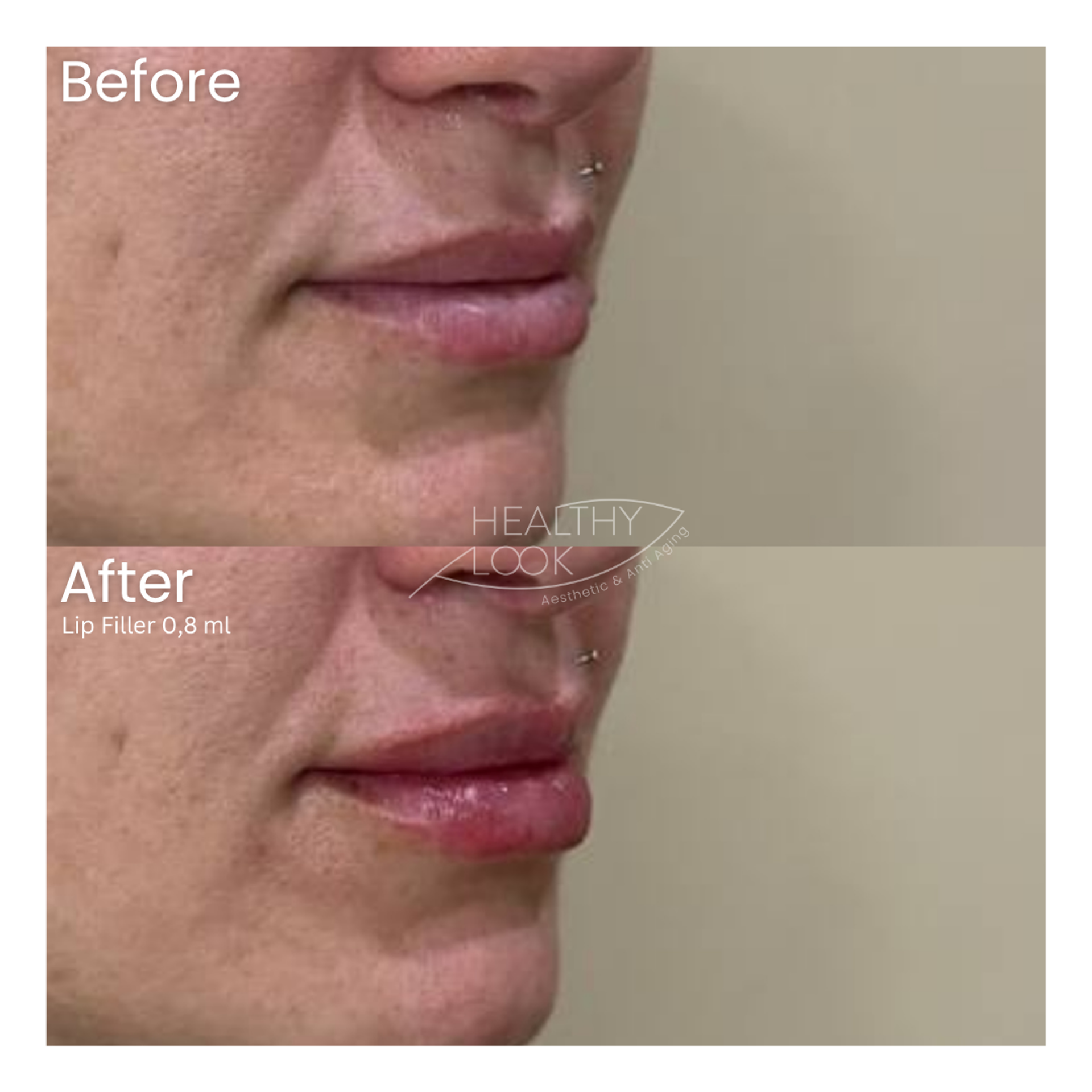 Before and after result 35 for Lip Filler treatment at Healthy Look Aesthetic