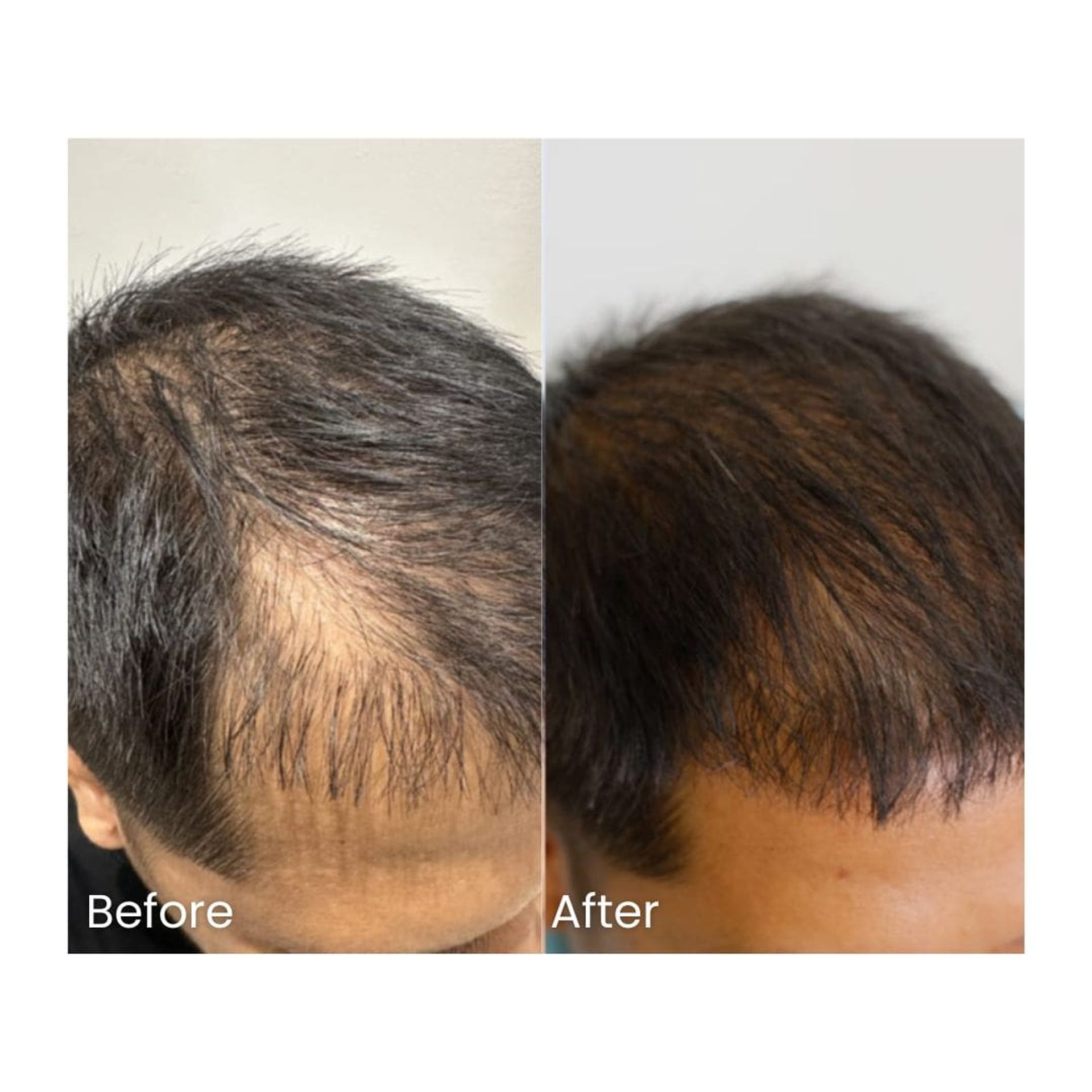 Before and after Autologous Micrograft Hair Restoration at Healthy Look Aesthetic, Ubud