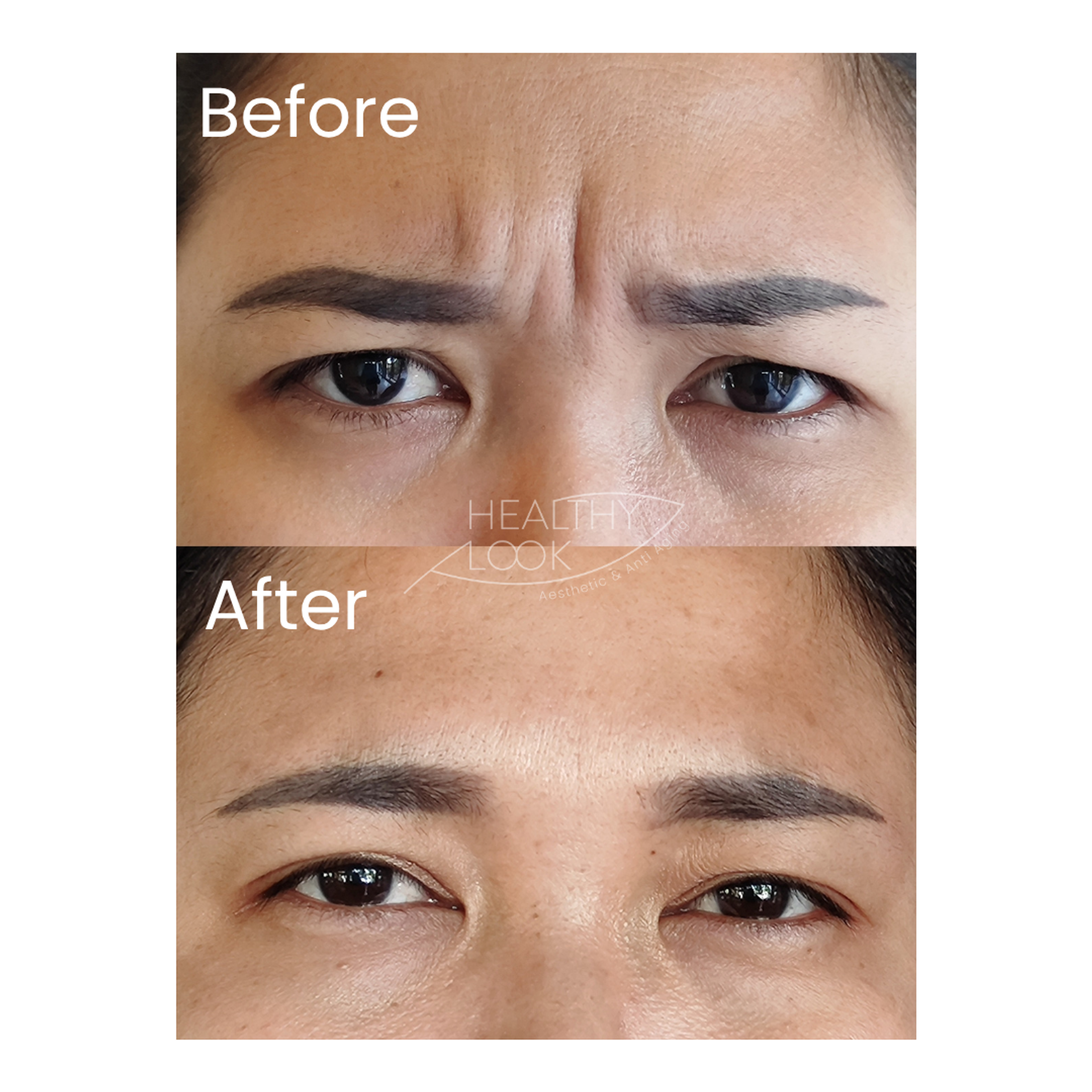 Before and after result 8 for Botox treatment at Healthy Look Aesthetic
