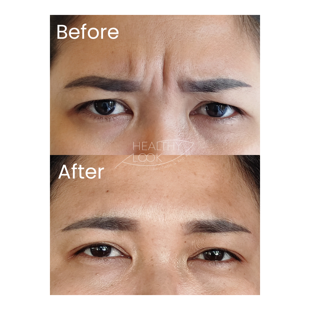Before and after result 8 for Botox treatment at Healthy Look Aesthetic