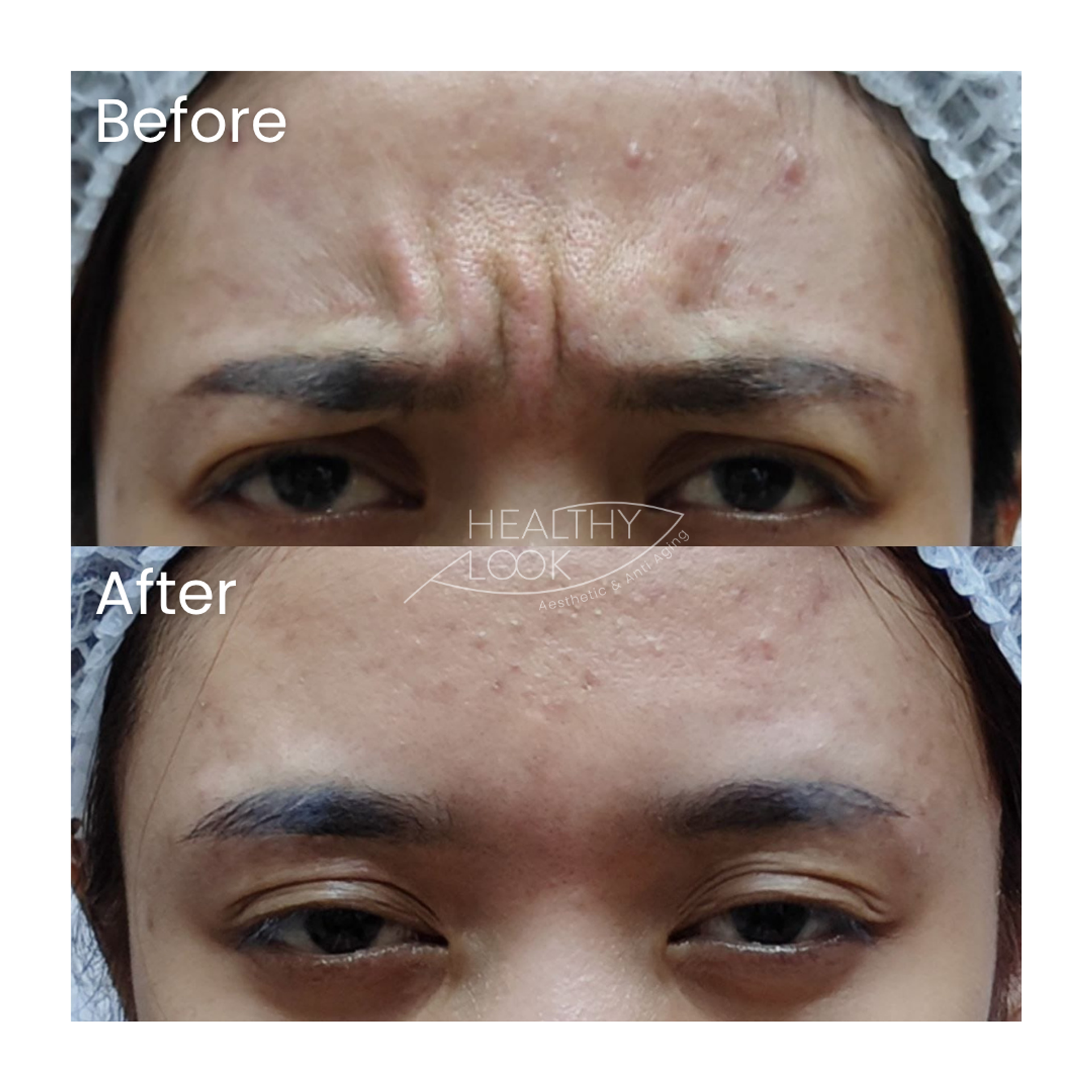 Before and after result 17 for Botox treatment at Healthy Look Aesthetic