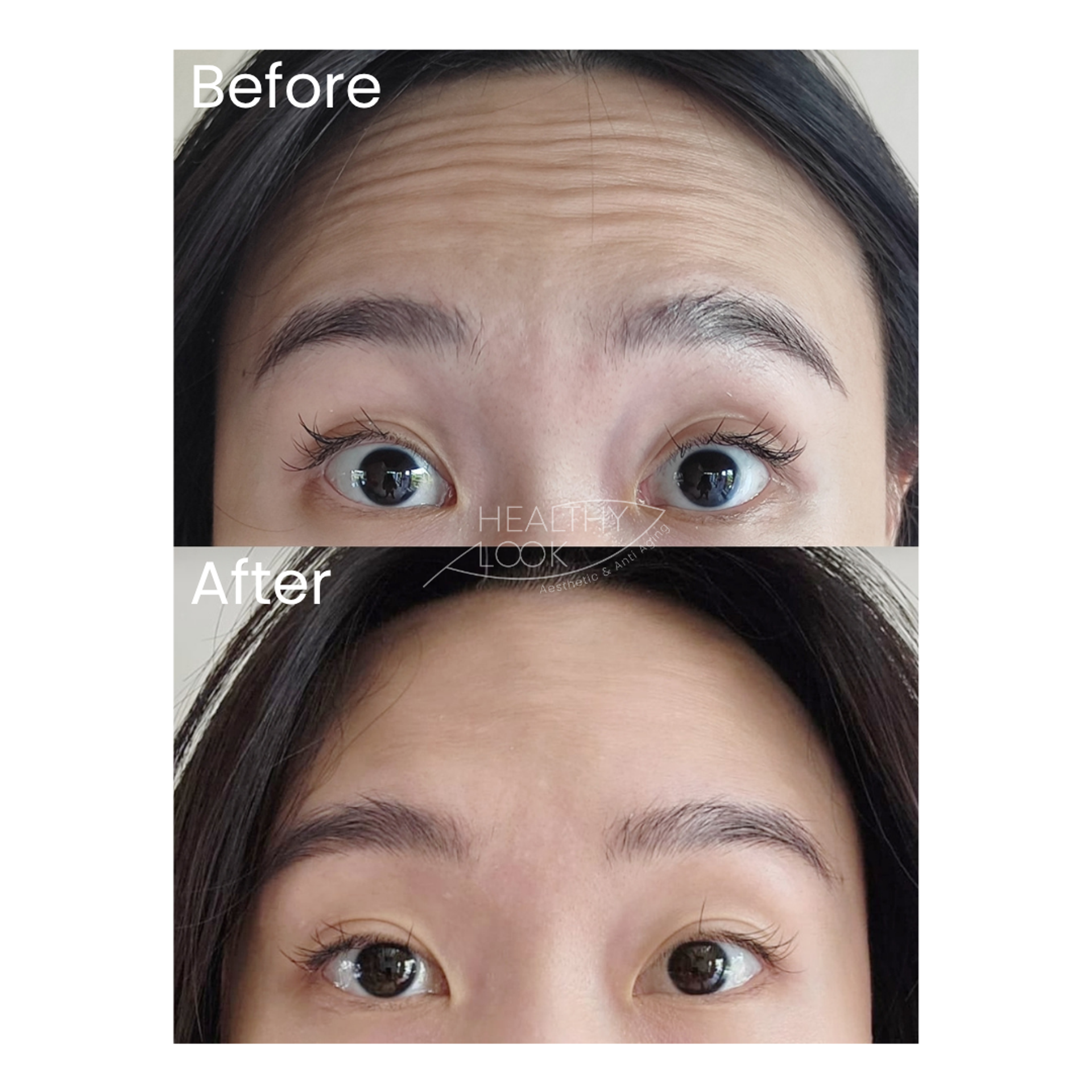 Before and after result 3 for Botox treatment at Healthy Look Aesthetic