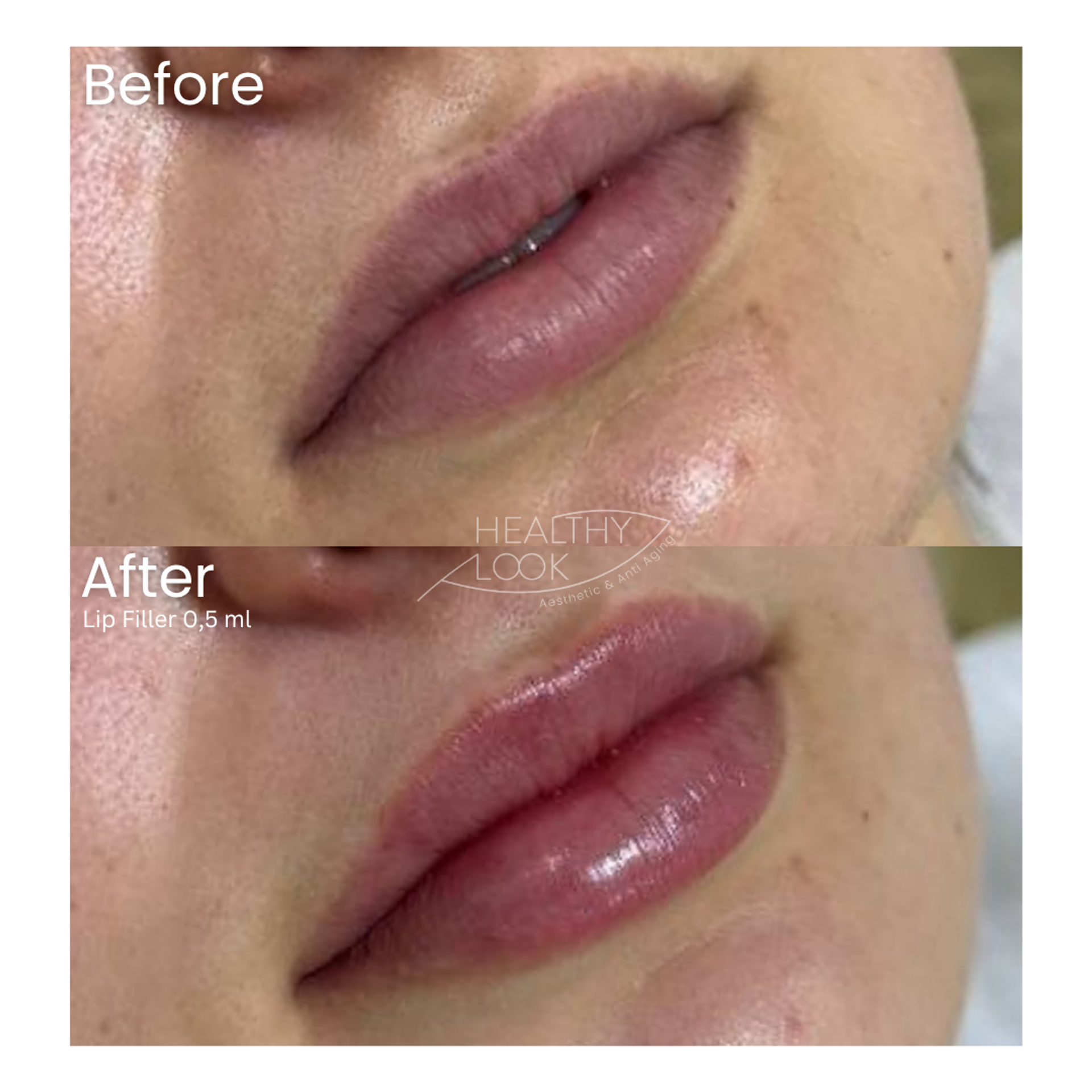 Before and after result 14 for Lip Filler treatment at Healthy Look Aesthetic
