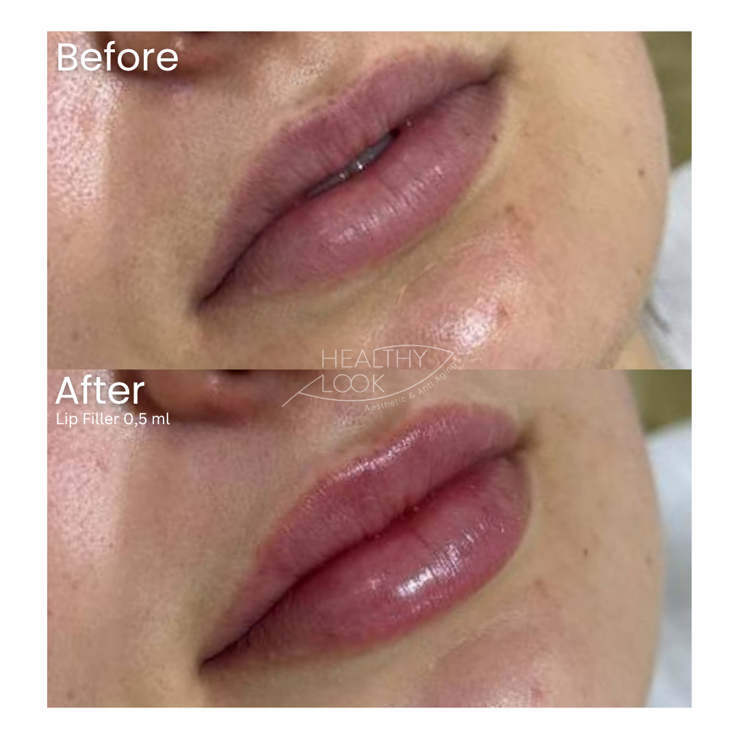 Before and after result 14 for Lip Filler treatment at Healthy Look Aesthetic