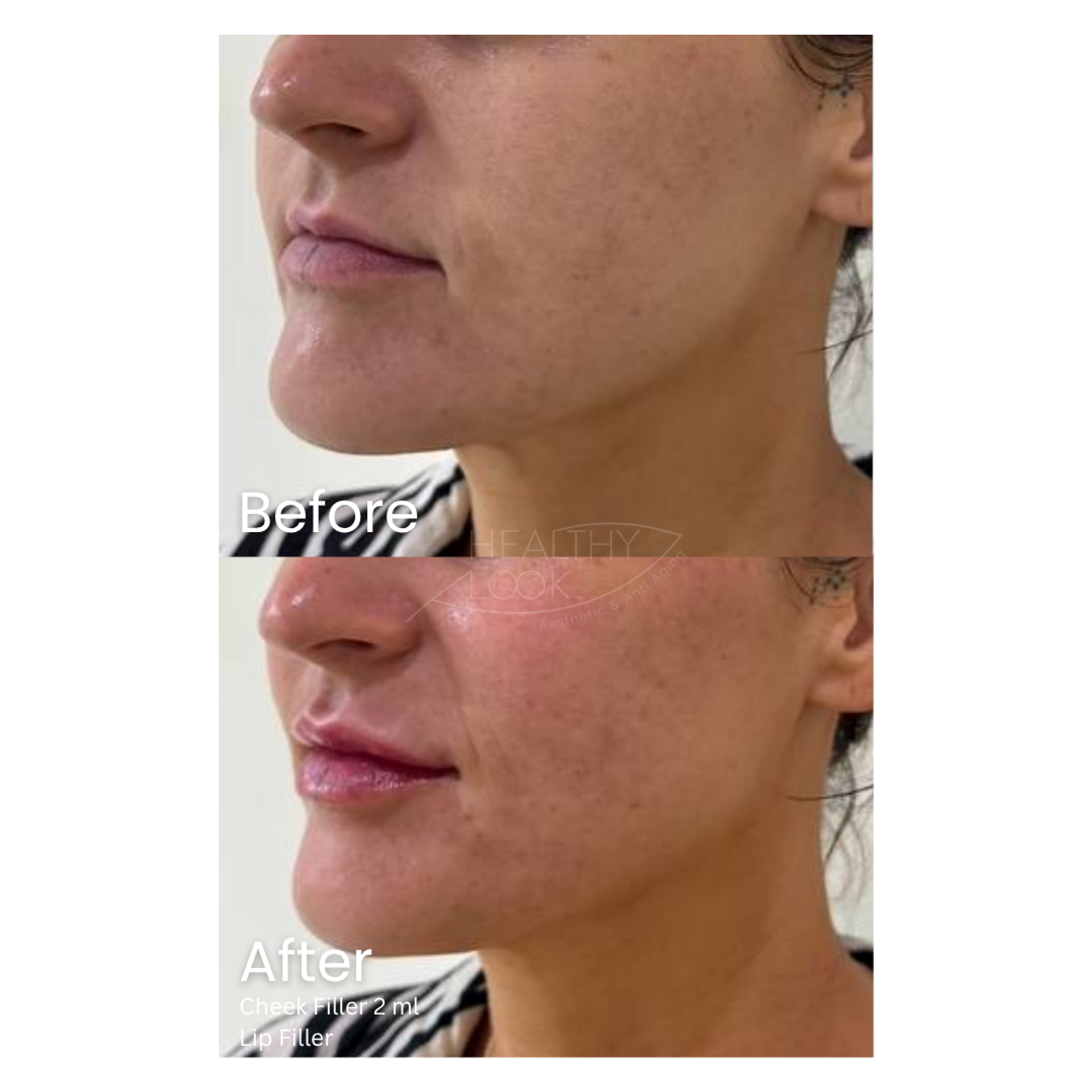 Before and after result 11 for Dermal Filler treatment at Healthy Look Aesthetic