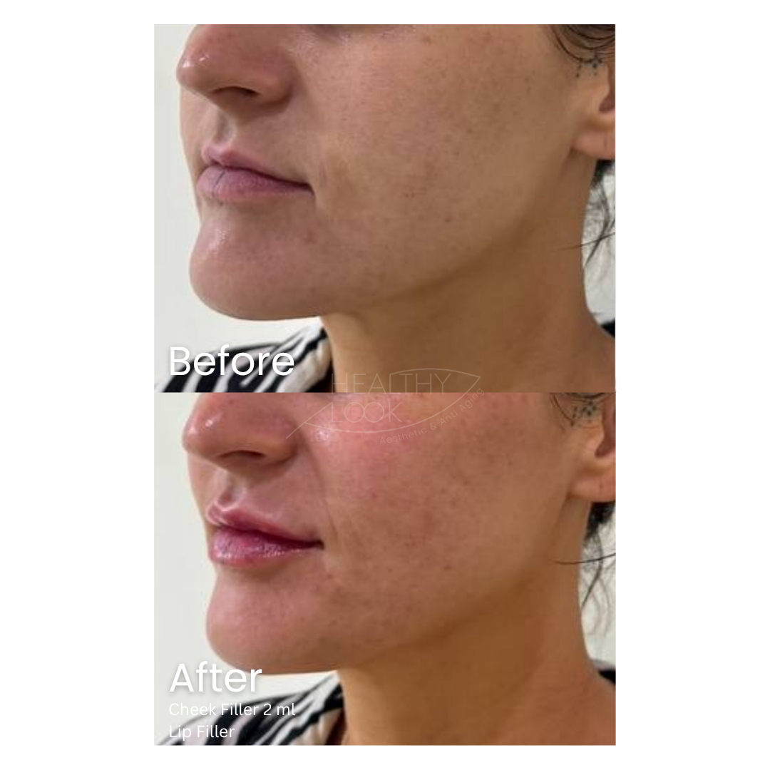 Before and after result 11 for Dermal Filler treatment at Healthy Look Aesthetic