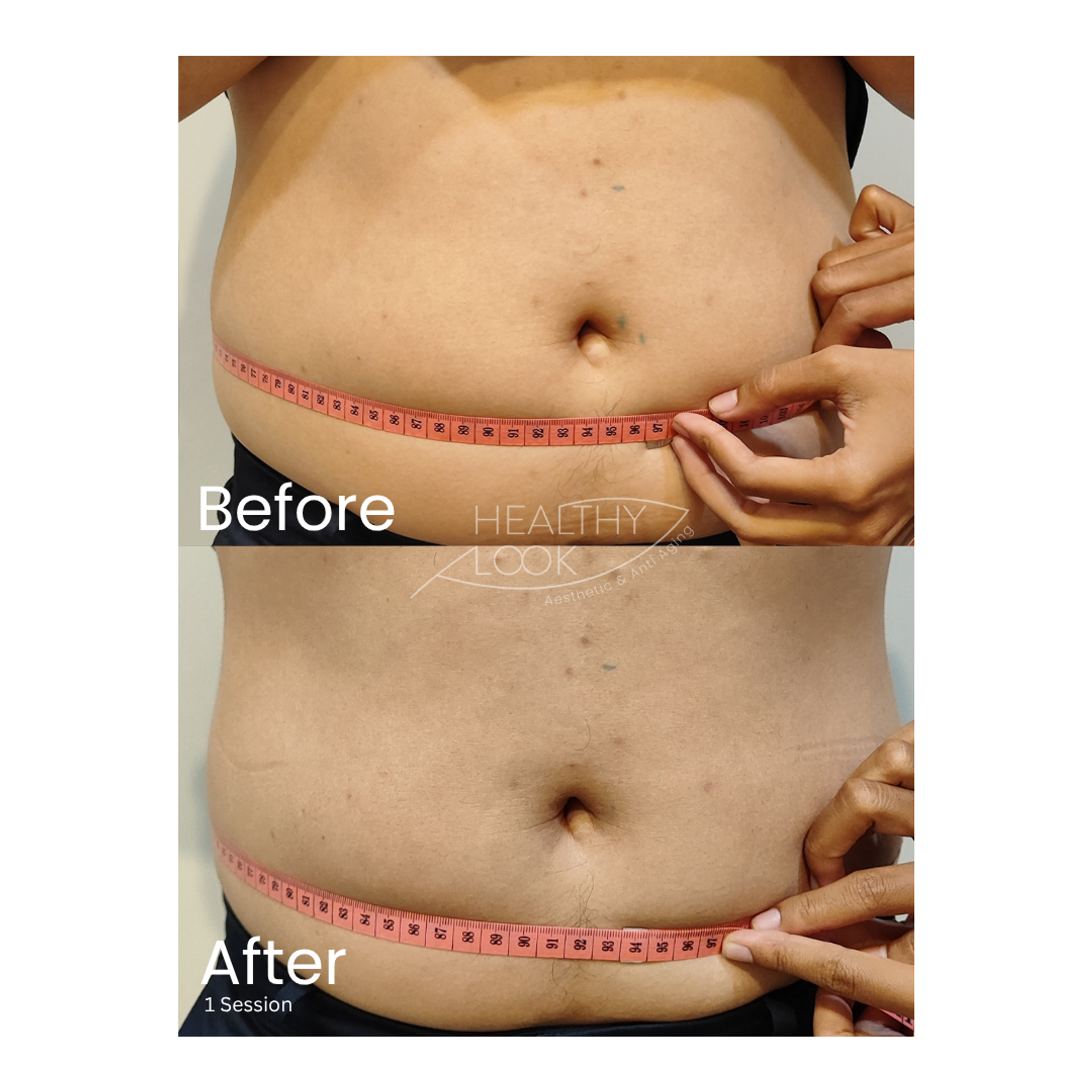 Before and after result 8 for CE Certified Muscle Sculpting by CM Slim treatment at Healthy Look Aesthetic