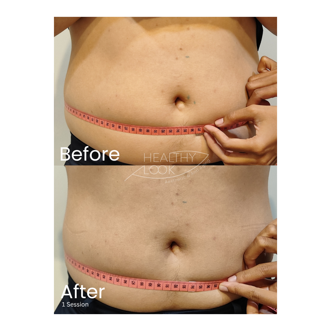 Before and after result 8 for CE Certified Muscle Sculpting by CM Slim treatment at Healthy Look Aesthetic
