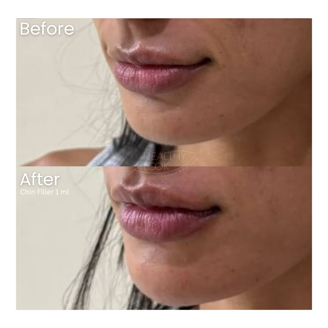 Before and after result 14 for Dermal Filler treatment at Healthy Look Aesthetic