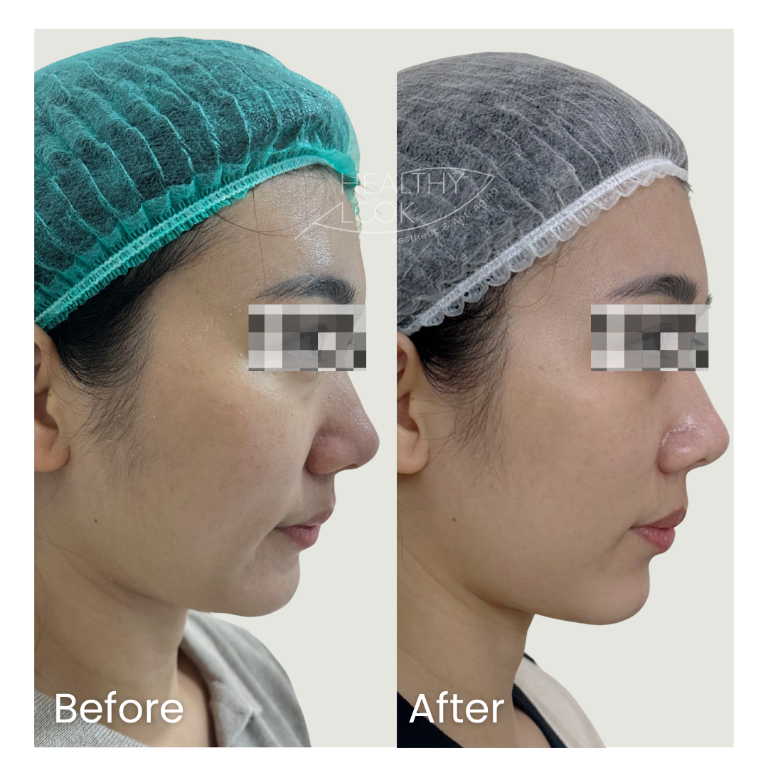 Before and after result 2 for Premium HIFU by Linear Z treatment at Healthy Look Aesthetic