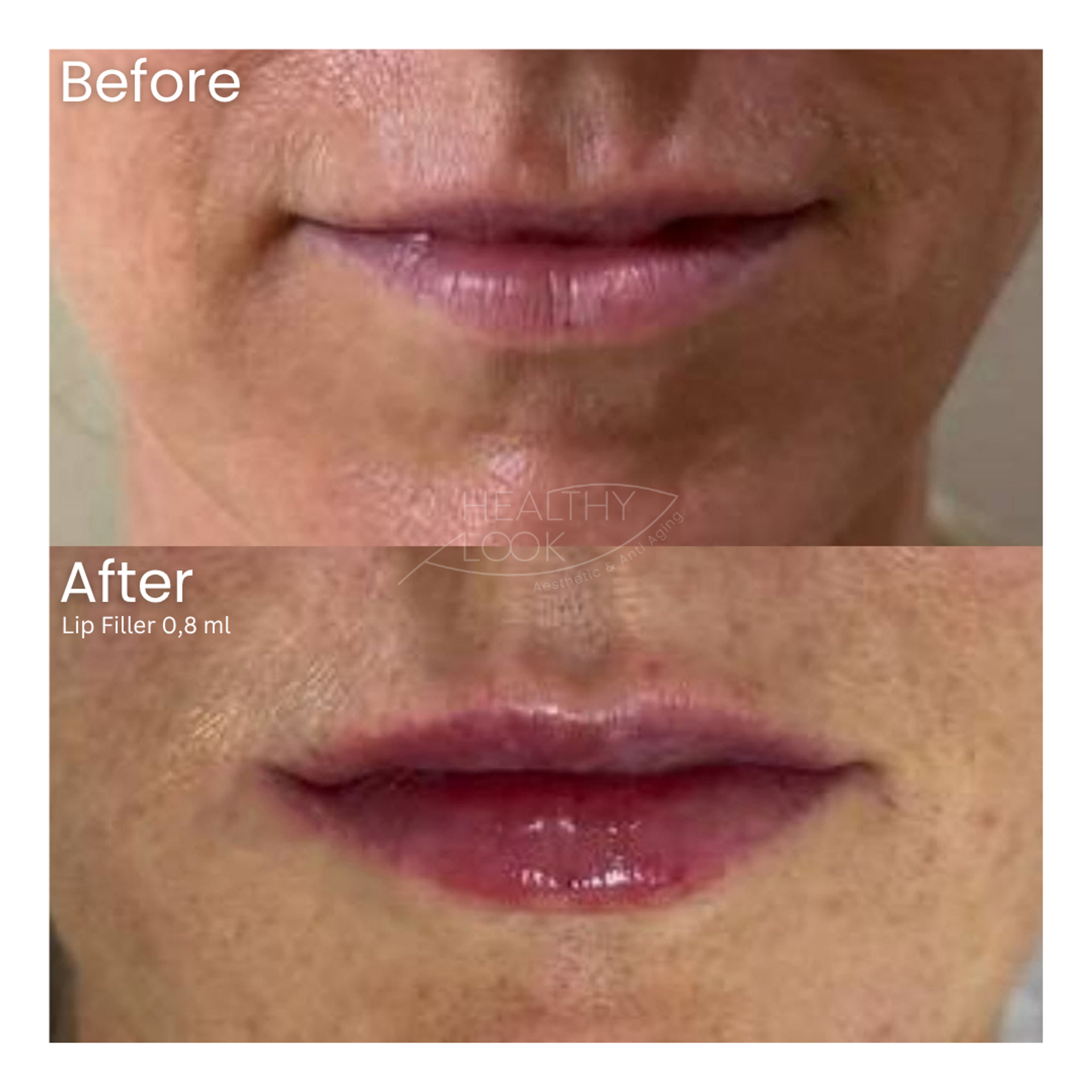 Before and after result 28 for Lip Filler treatment at Healthy Look Aesthetic