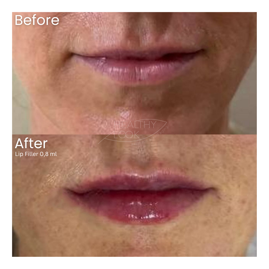 Before and after result 28 for Lip Filler treatment at Healthy Look Aesthetic