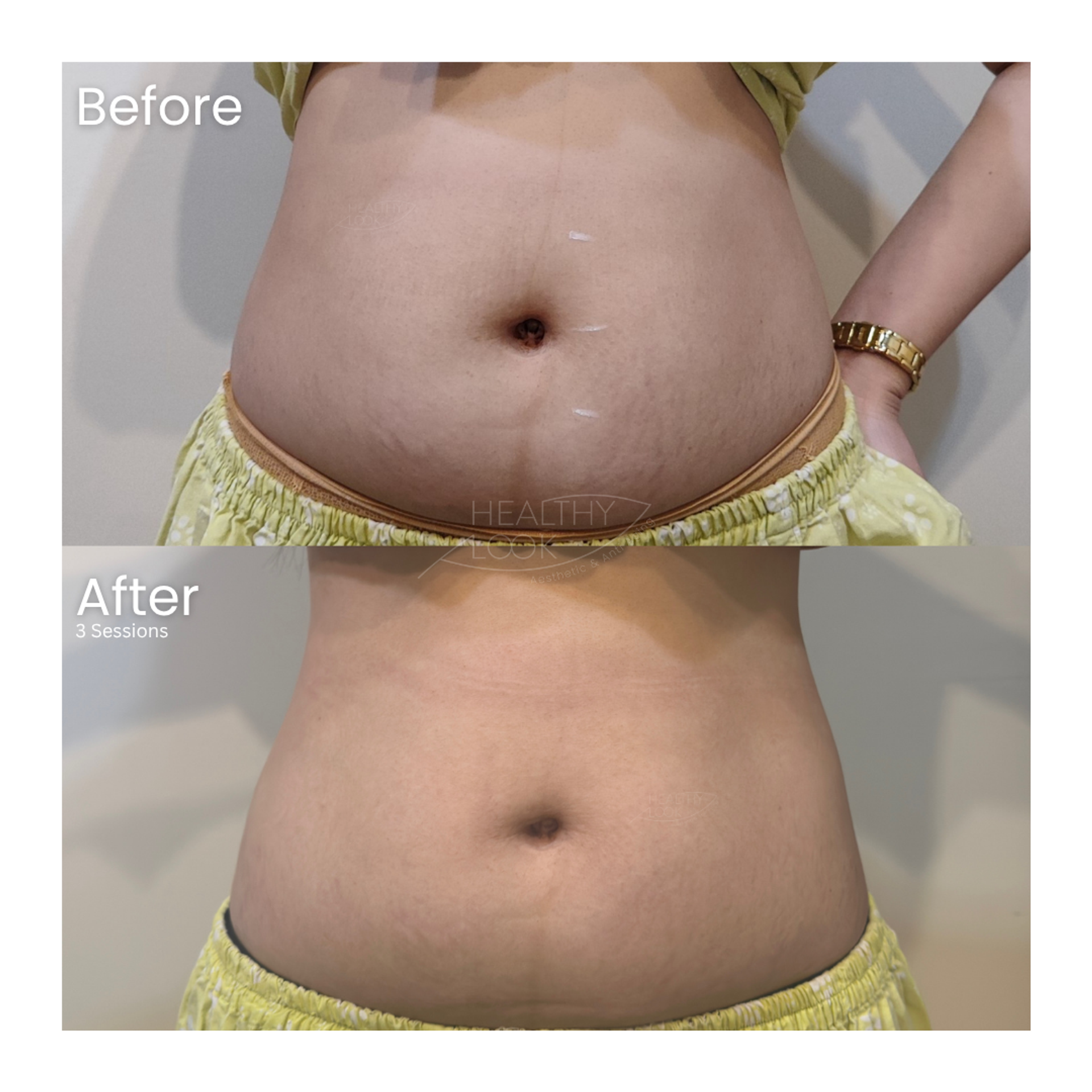 Before and after result 4 for Lysiwave treatment at Healthy Look Aesthetic