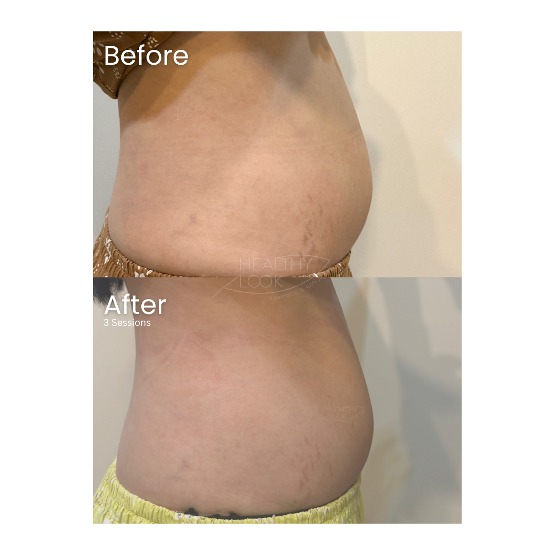 Before and after result 3 for Lysiwave treatment at Healthy Look Aesthetic