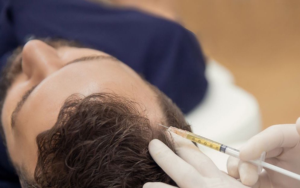 Micrograft suspension injected into the scalp