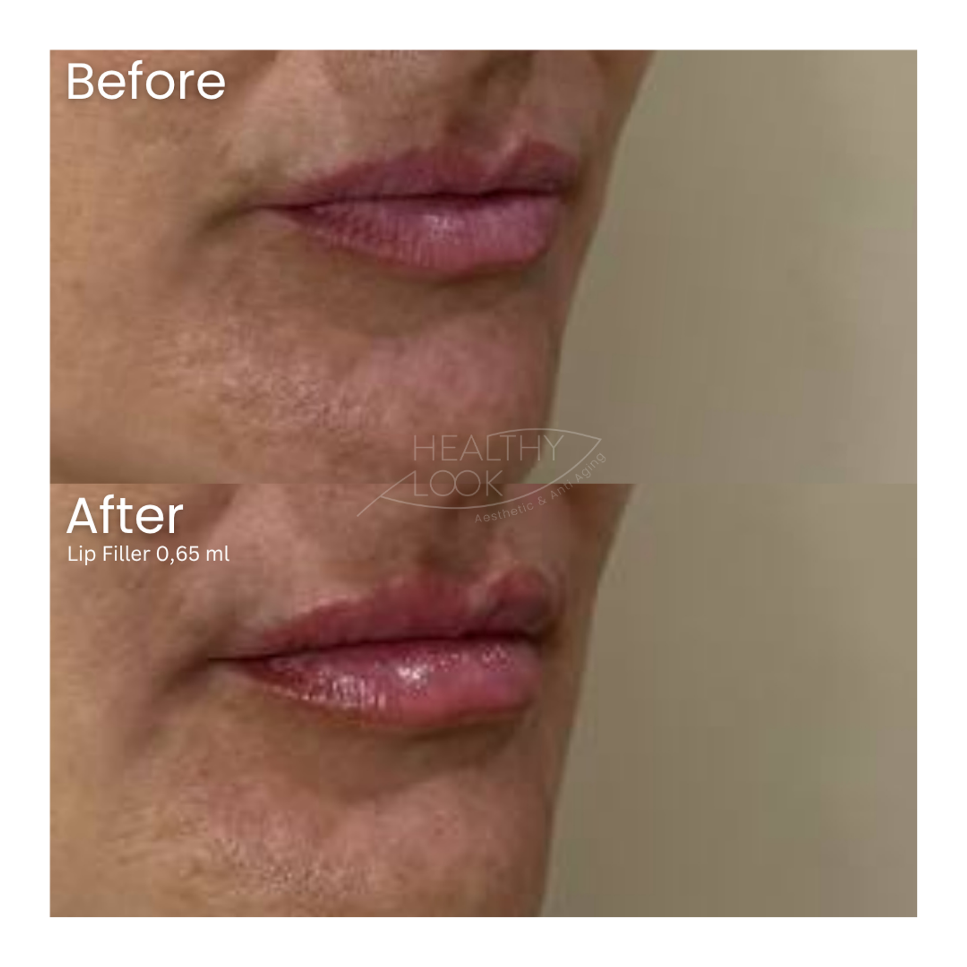 Before and after result 26 for Lip Filler treatment at Healthy Look Aesthetic