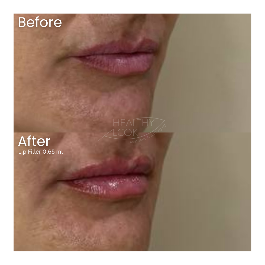 Before and after result 26 for Lip Filler treatment at Healthy Look Aesthetic