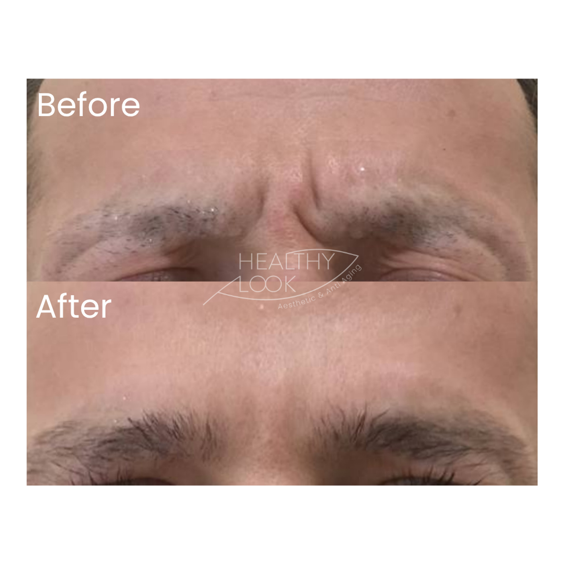 Before and after result 7 for Botox treatment at Healthy Look Aesthetic