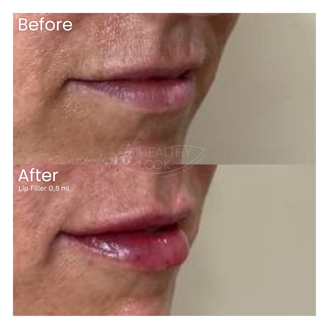 Before and after result 27 for Lip Filler treatment at Healthy Look Aesthetic