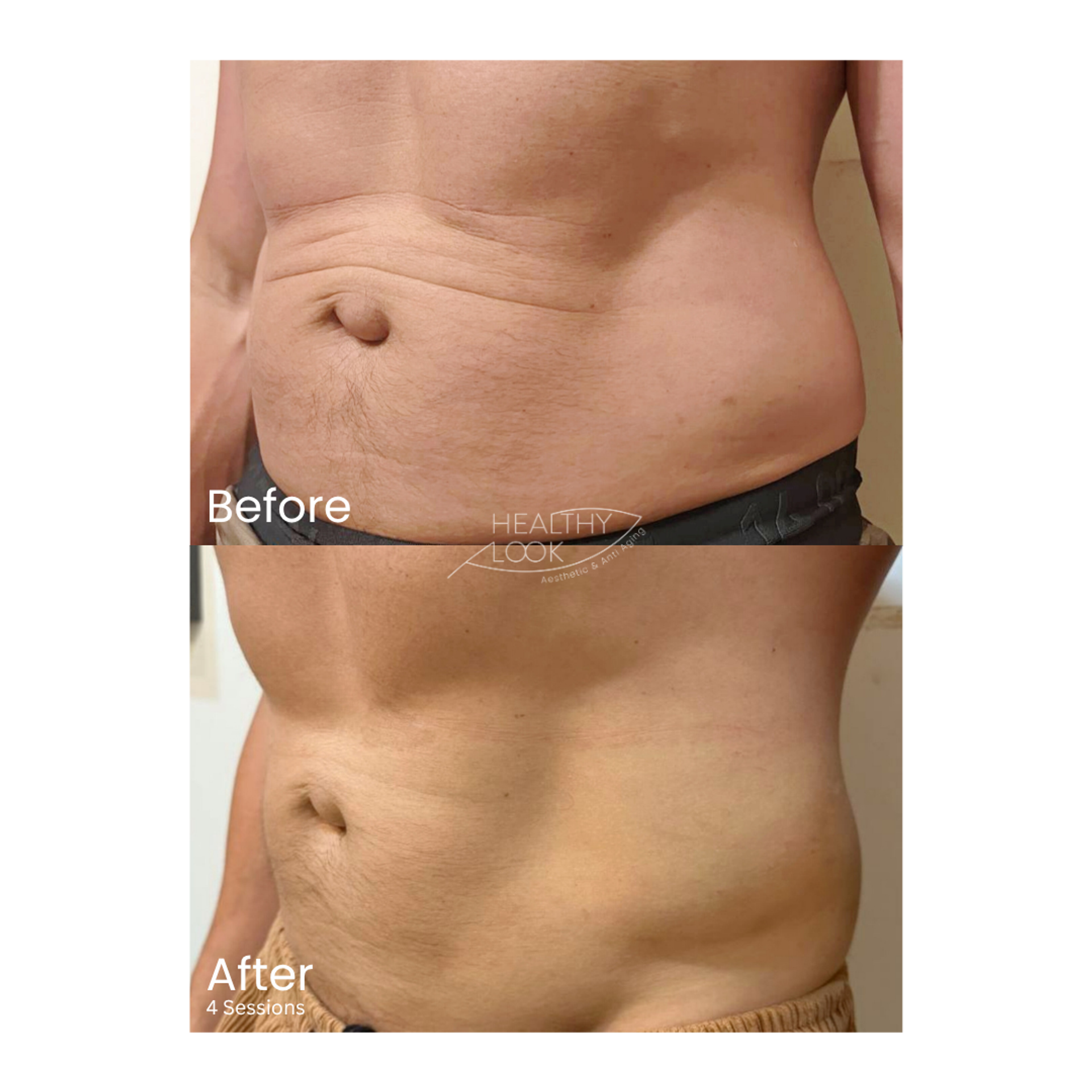 Before and after result 5 for CE Certified Muscle Sculpting by CM Slim treatment at Healthy Look Aesthetic
