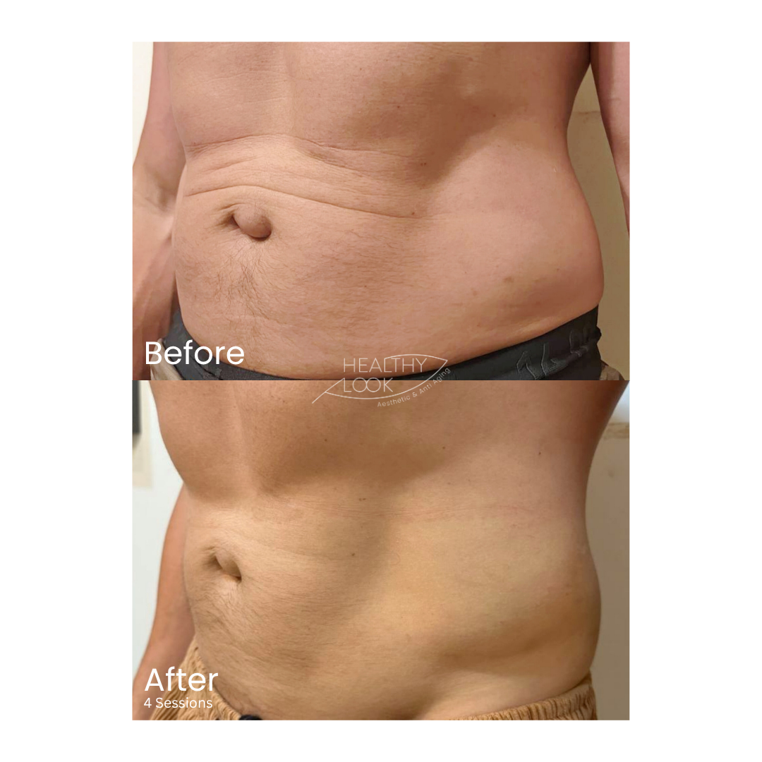 Before and after result 5 for CE Certified Muscle Sculpting by CM Slim treatment at Healthy Look Aesthetic