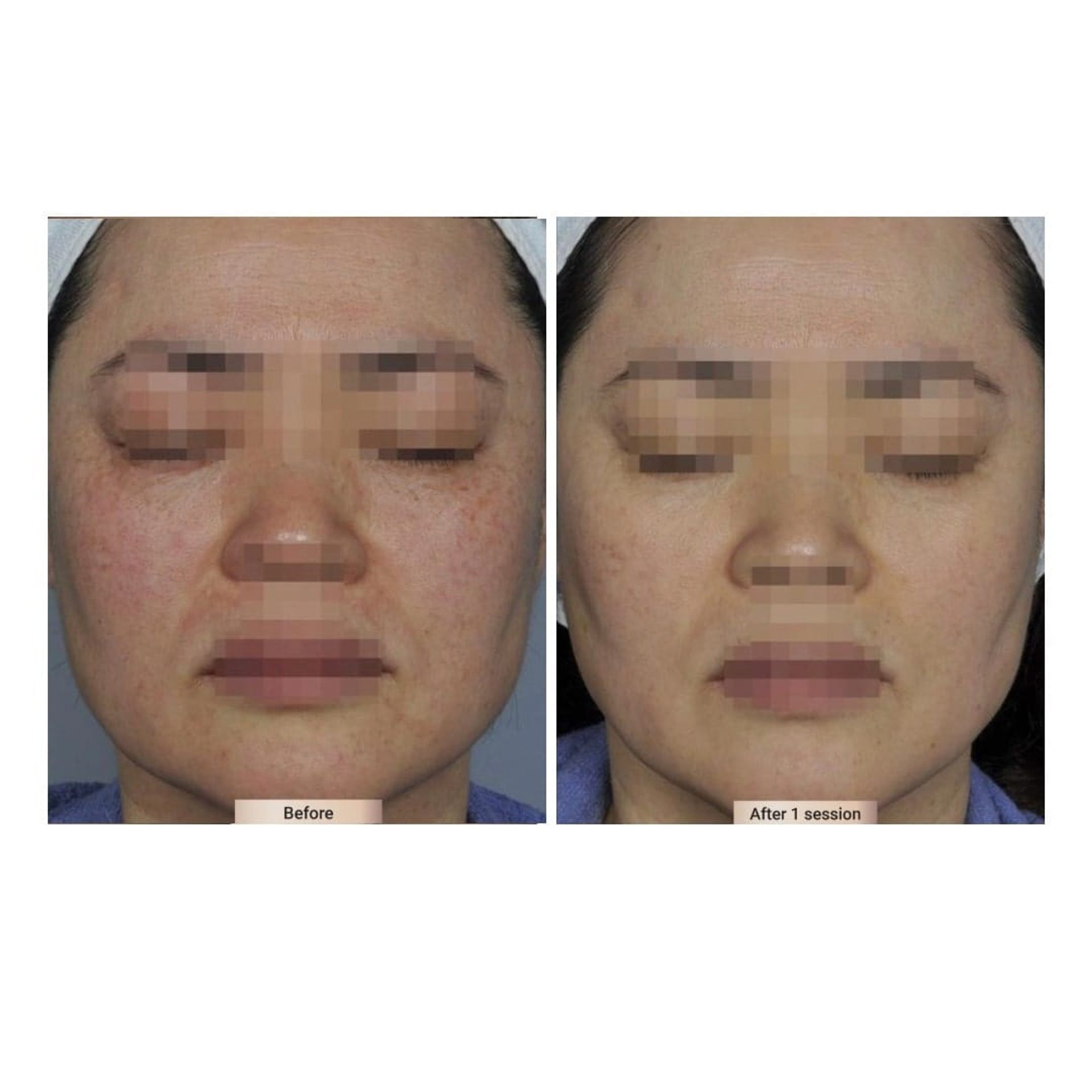 Before and after result 4 for Sylfirm X treatment at Healthy Look Aesthetic