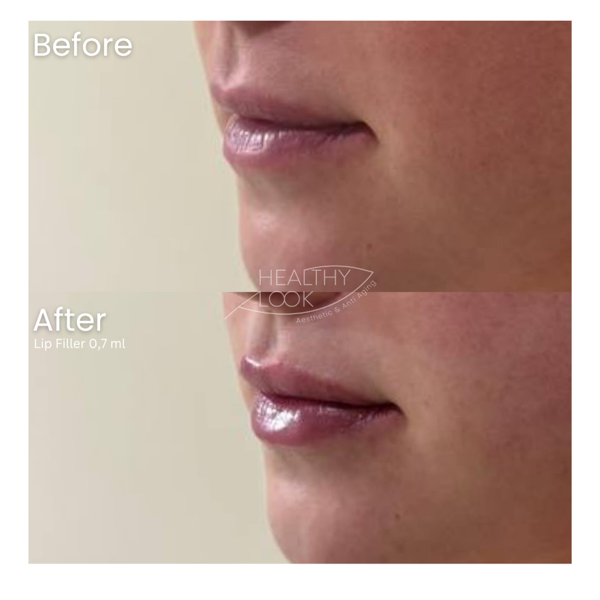 Before and after result 31 for Lip Filler treatment at Healthy Look Aesthetic