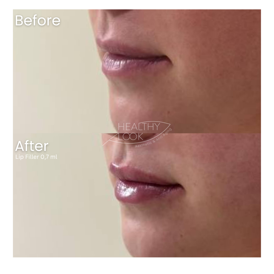Before and after result 31 for Lip Filler treatment at Healthy Look Aesthetic