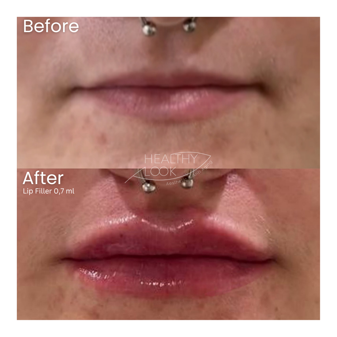 Before and after result 12 for Lip Filler treatment at Healthy Look Aesthetic