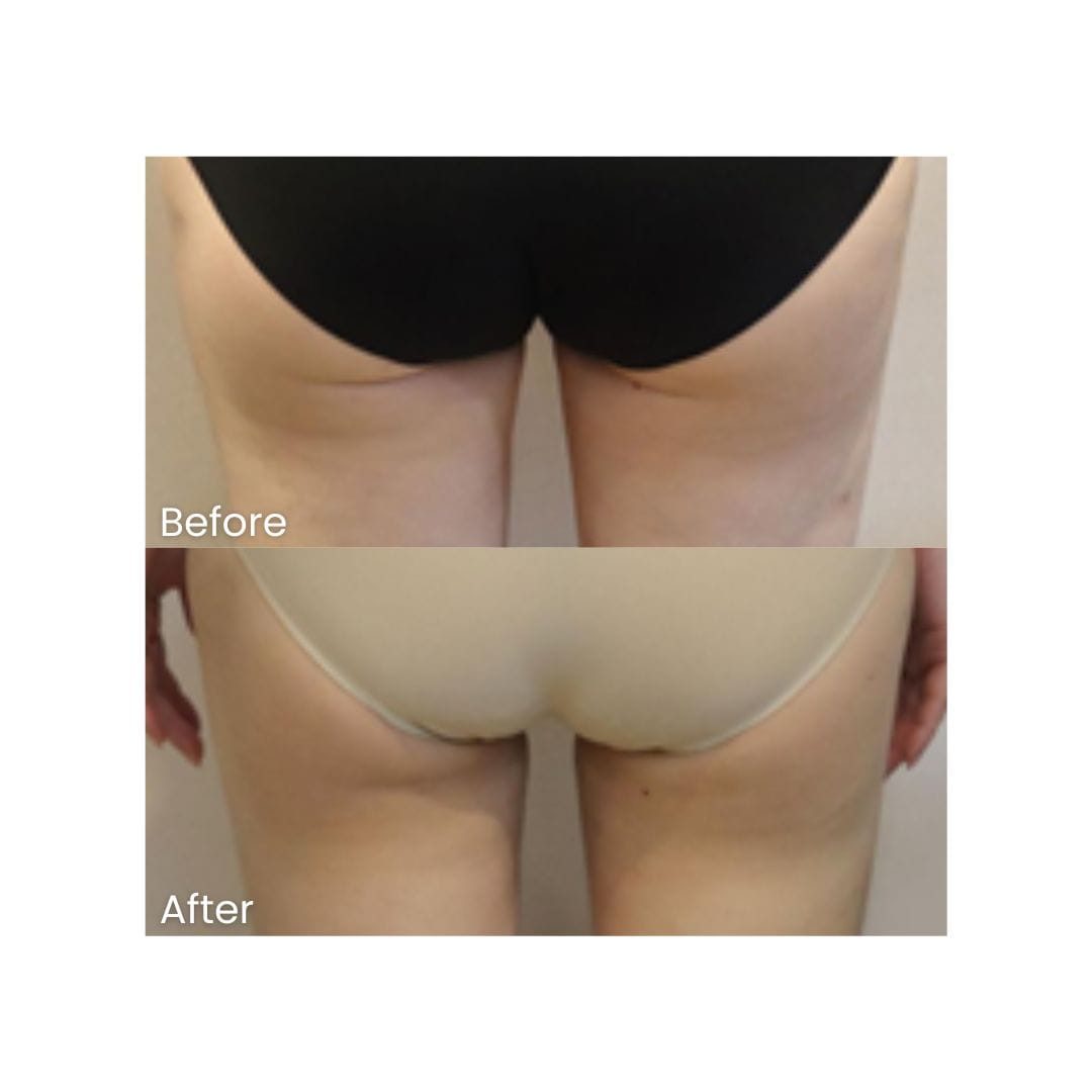 Before and after HIFU Body at Healthy Look Aesthetic, Ubud