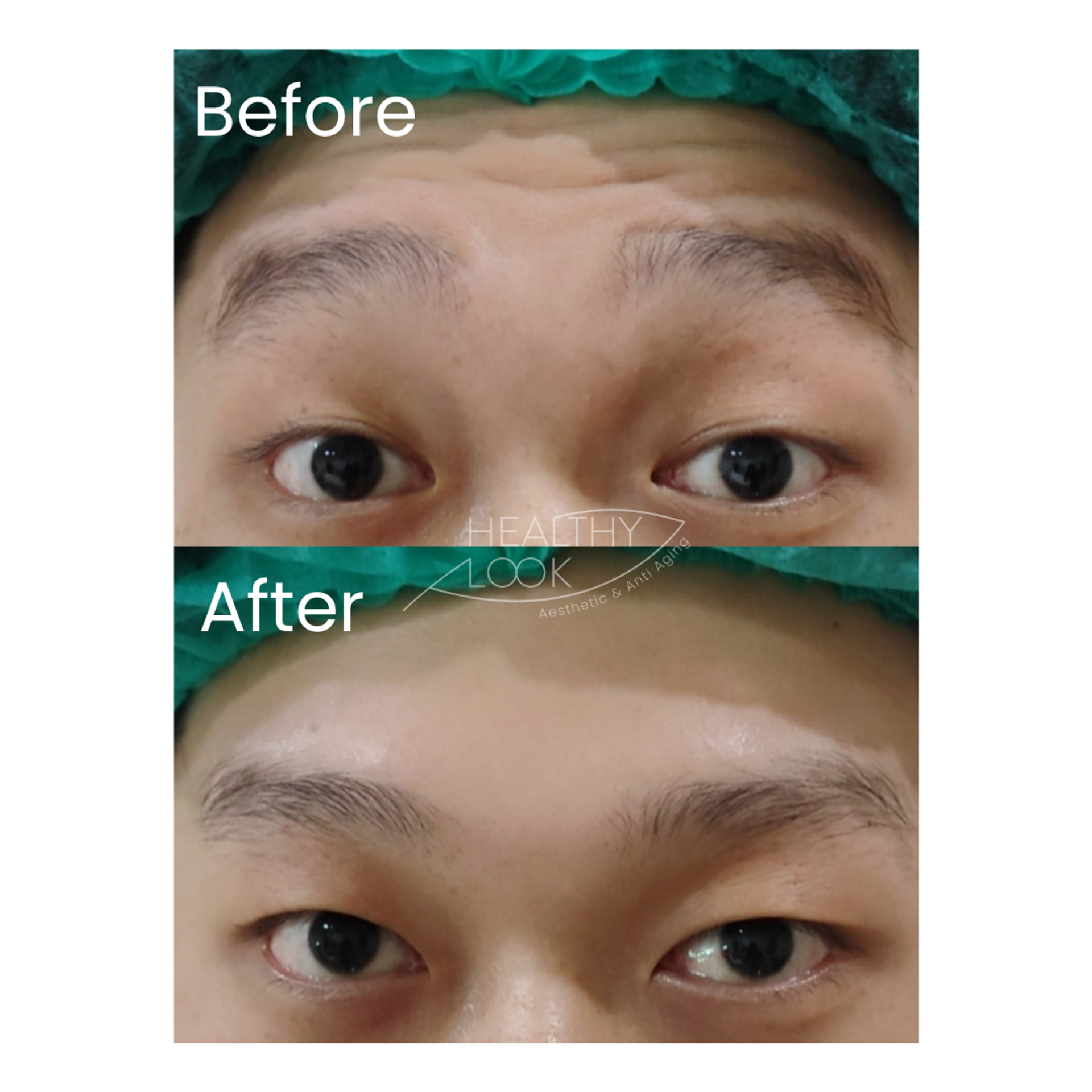 Before and after result 10 for Botox treatment at Healthy Look Aesthetic