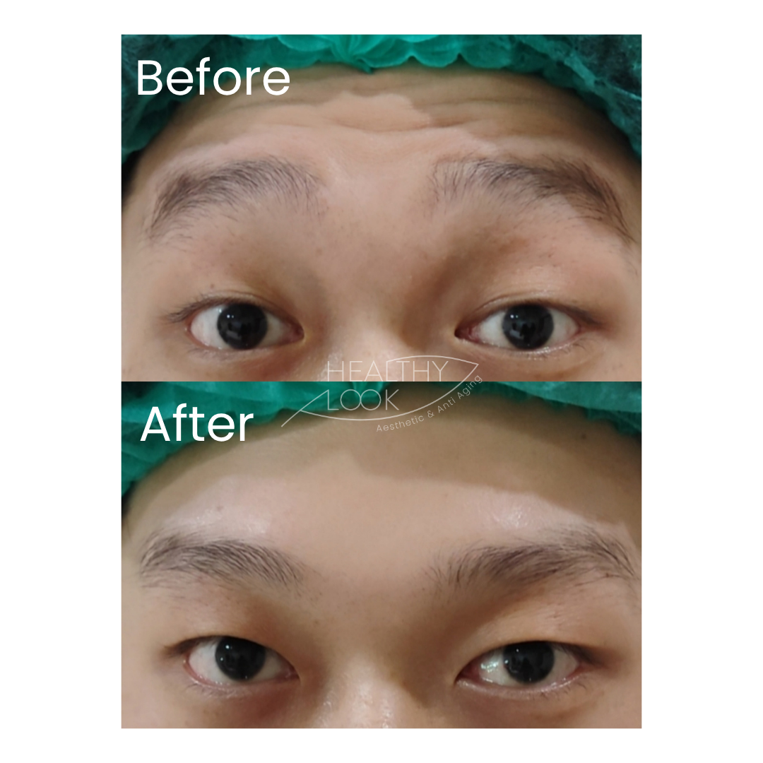 Before and after result 10 for Botox treatment at Healthy Look Aesthetic