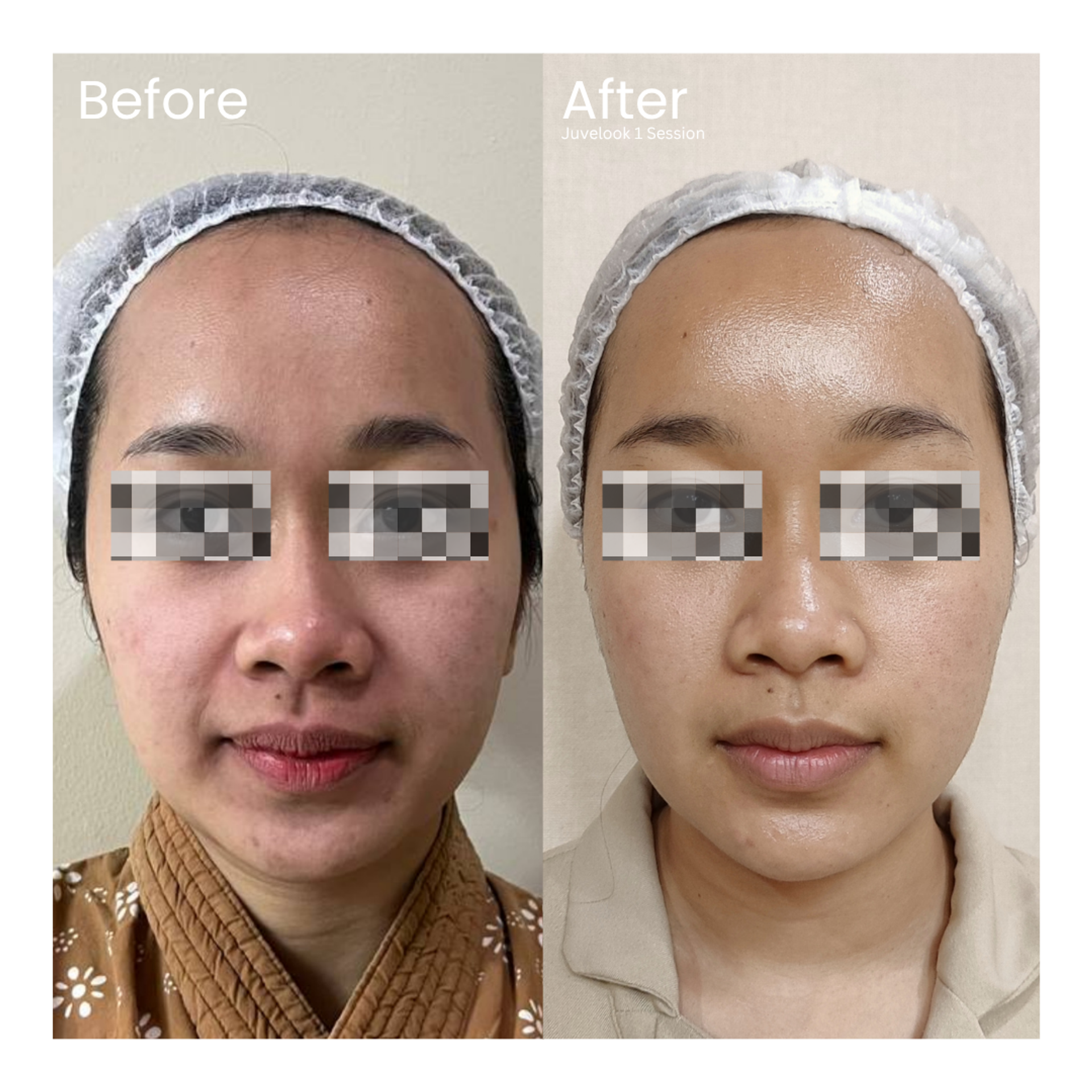 Before and after result 9 for Skin Treatment treatment at Healthy Look Aesthetic
