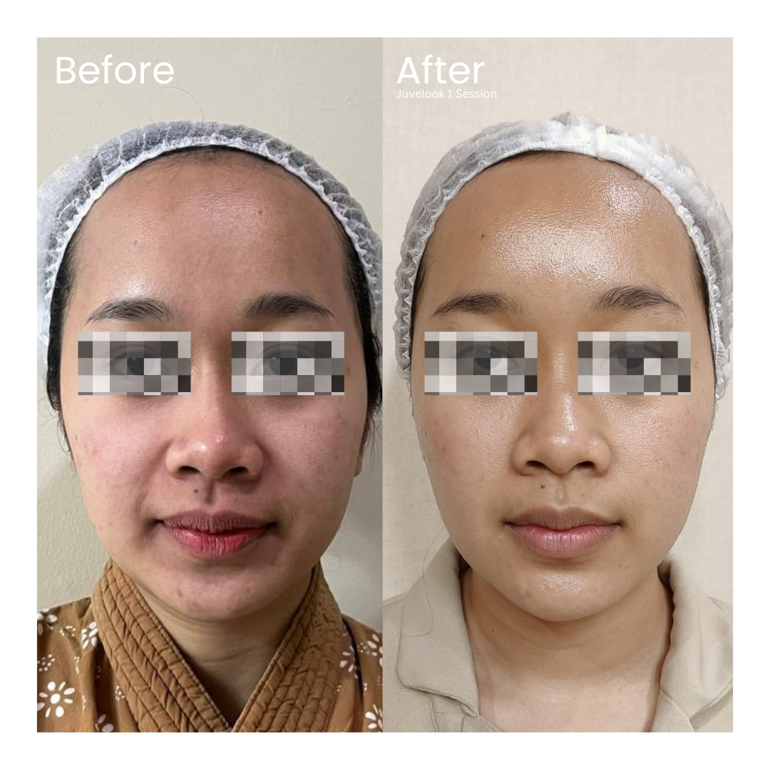 Before and after result 9 for Skin Treatment treatment at Healthy Look Aesthetic