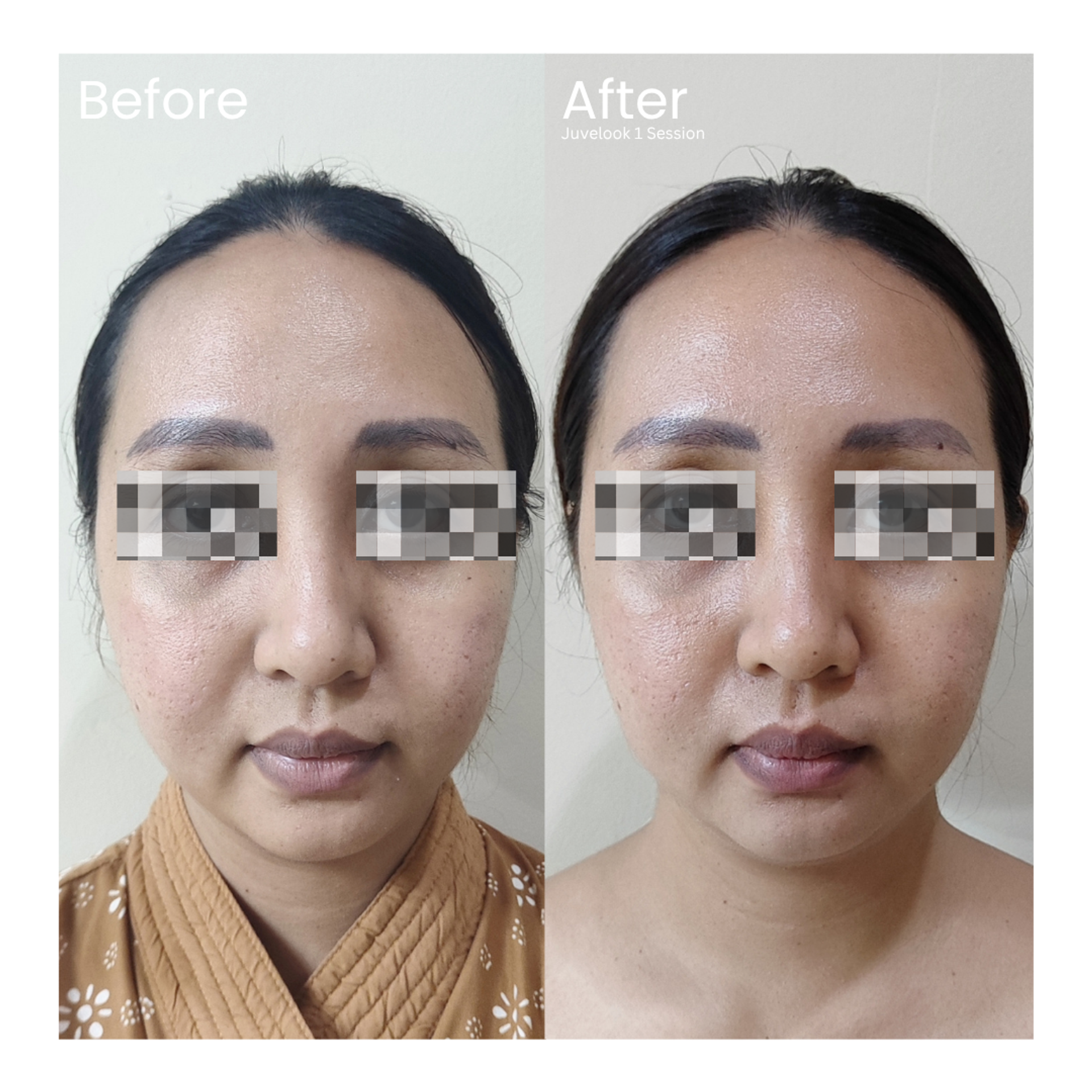Before and after result 5 for Skin Treatment treatment at Healthy Look Aesthetic